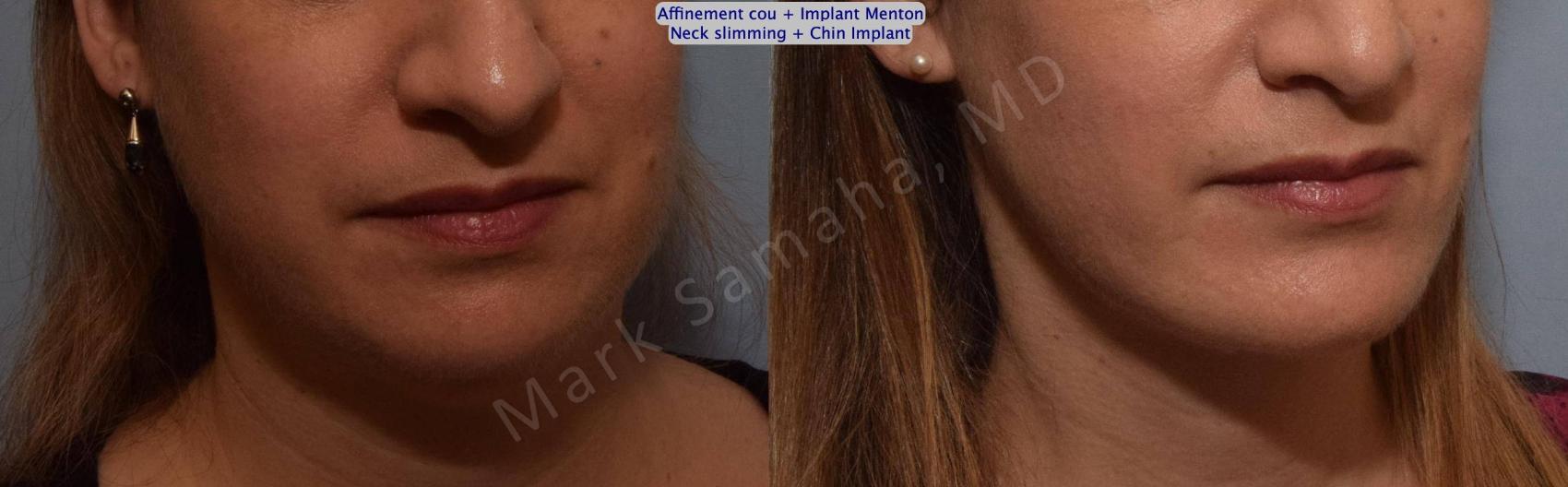Before & After Chirurgie d'affinement du visage / Face slimming-Face contouring Case 161 Right Oblique View in Mount Royal, QC