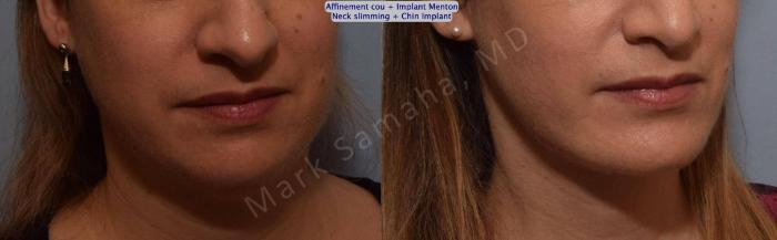 Before & After Chirurgie d’affinement du visage / Face Slimming Surgery Case 161 Right Oblique View in Montreal, QC