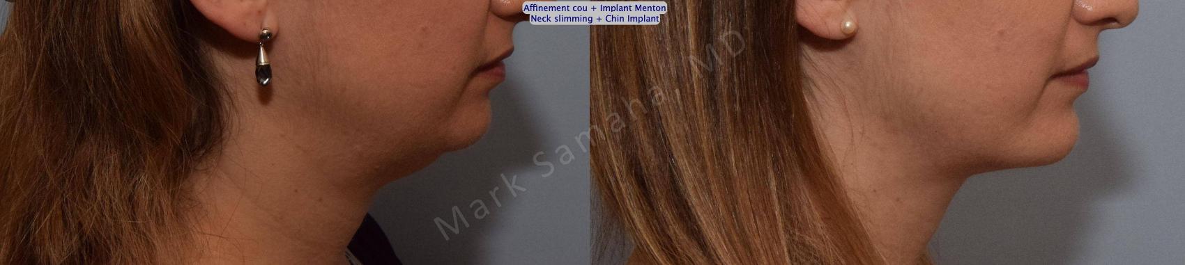 Before & After Chirurgie d’affinement du visage / Face Slimming Surgery Case 161 Right Side View in Montreal, QC