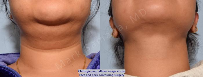 Before & After Chirurgie d’affinement du visage / Face Slimming Surgery Case 204 Basal View in Montreal, QC