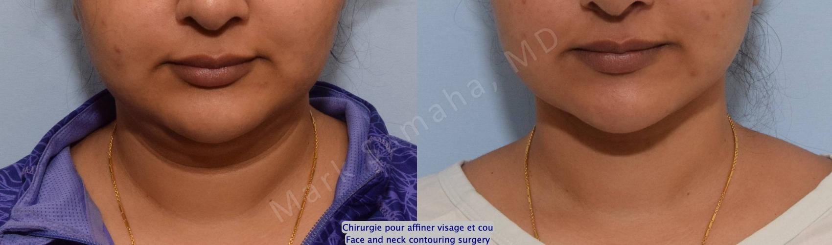 Before & After Chirurgie d’affinement du visage / Face Slimming Surgery Case 204 Front View in Montreal, QC