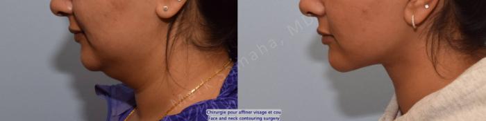 Before & After Chirurgie d’affinement du visage / Face Slimming Surgery Case 204 Left Side View in Montreal, QC