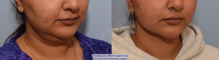 Before & After Chirurgie d’affinement du visage / Face Slimming Surgery Case 204 Right Oblique View in Montreal, QC