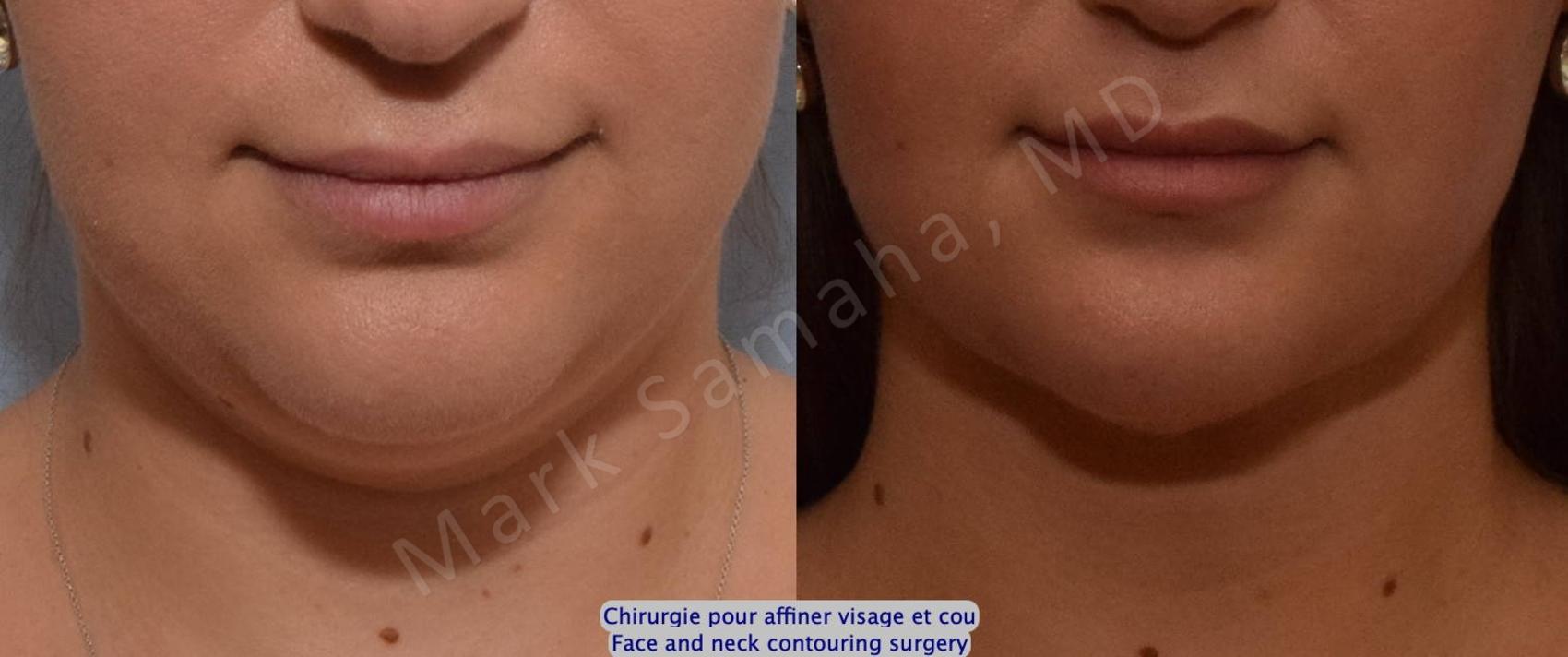 Before & After Chirurgie d’affinement du visage / Face Slimming Surgery Case 205 Front View in Montreal, QC