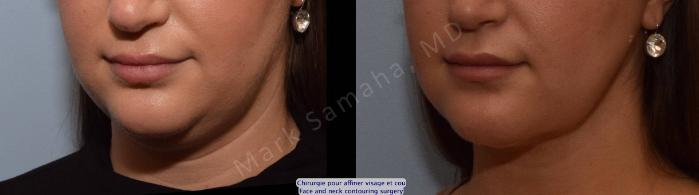 Before & After Chirurgie d’affinement du visage / Face Slimming Surgery Case 205 Left Oblique View in Montreal, QC