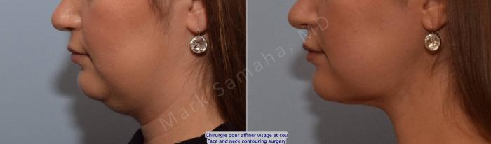 Before & After Chirurgie d’affinement du visage / Face Slimming Surgery Case 205 Left Side View in Montreal, QC