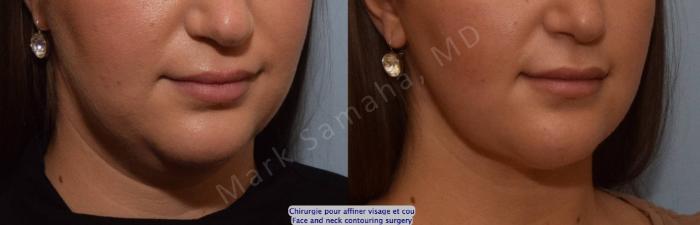 Before & After Chirurgie d’affinement du visage / Face Slimming Surgery Case 205 Right Oblique View in Montreal, QC