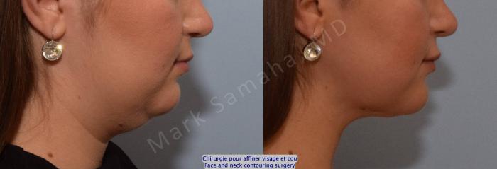 Before & After Chirurgie d’affinement du visage / Face Slimming Surgery Case 205 Right Side View in Montreal, QC