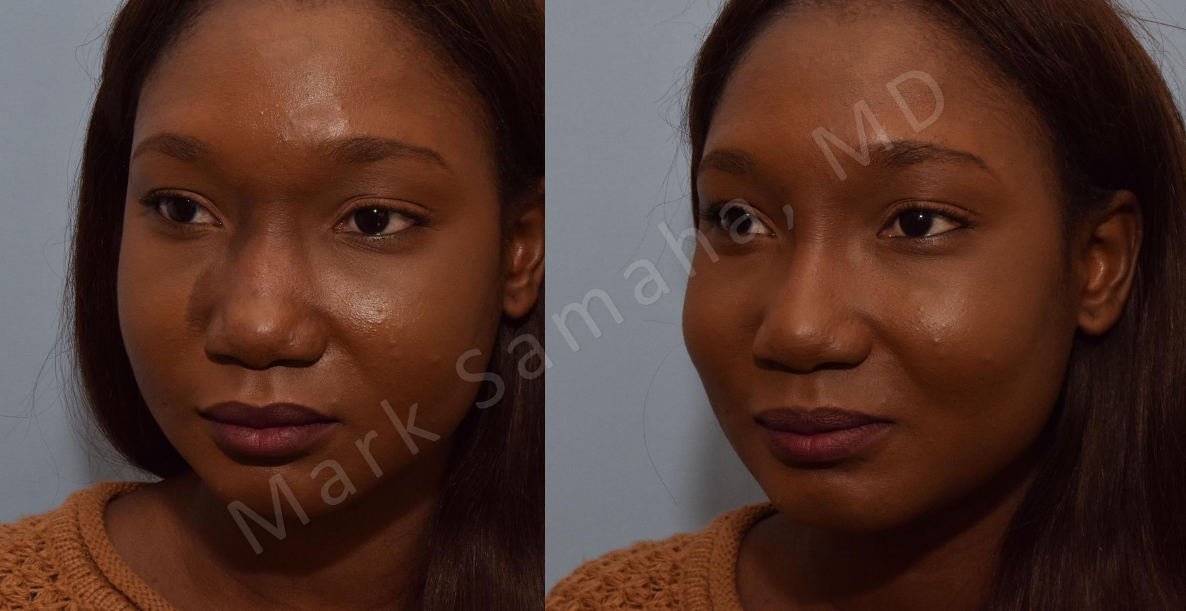 Before & After Agents de Comblement-Remplisseurs / Dermal Fillers Case 94 View #5 View in Mount Royal, QC