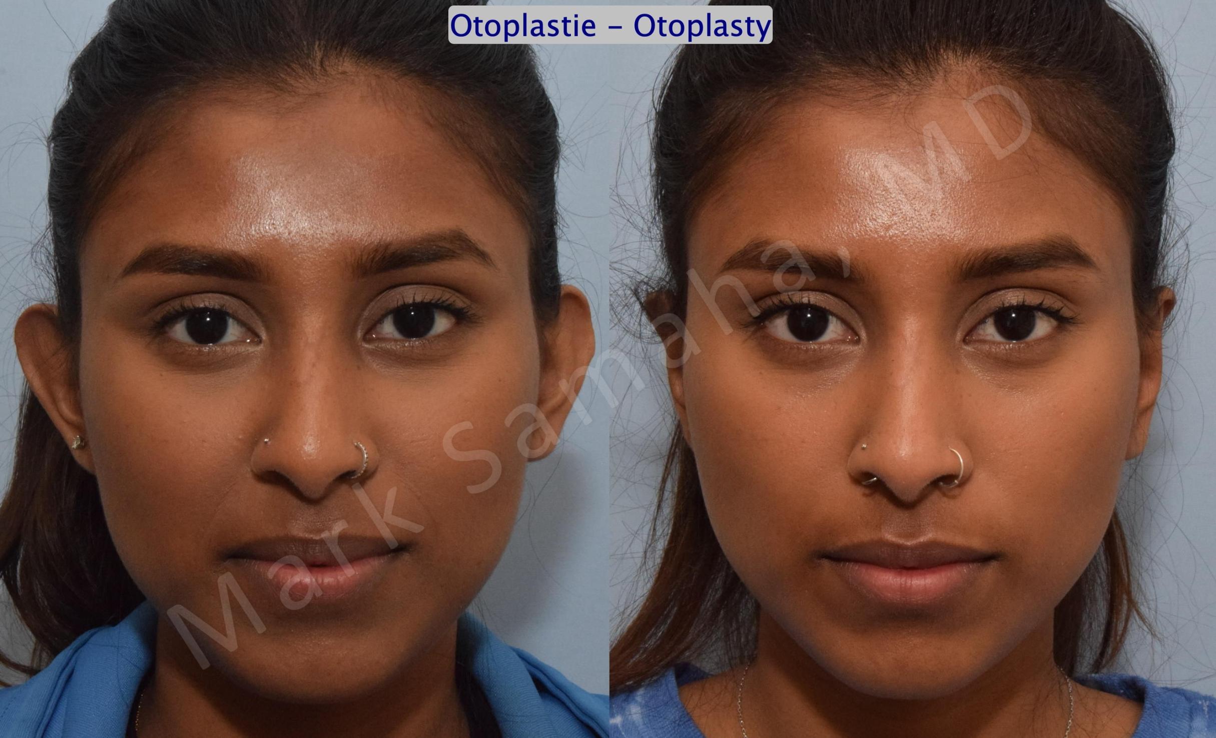 Before & After Otoplastie / Ear Surgery Case 180 Front View in Mount Royal, QC