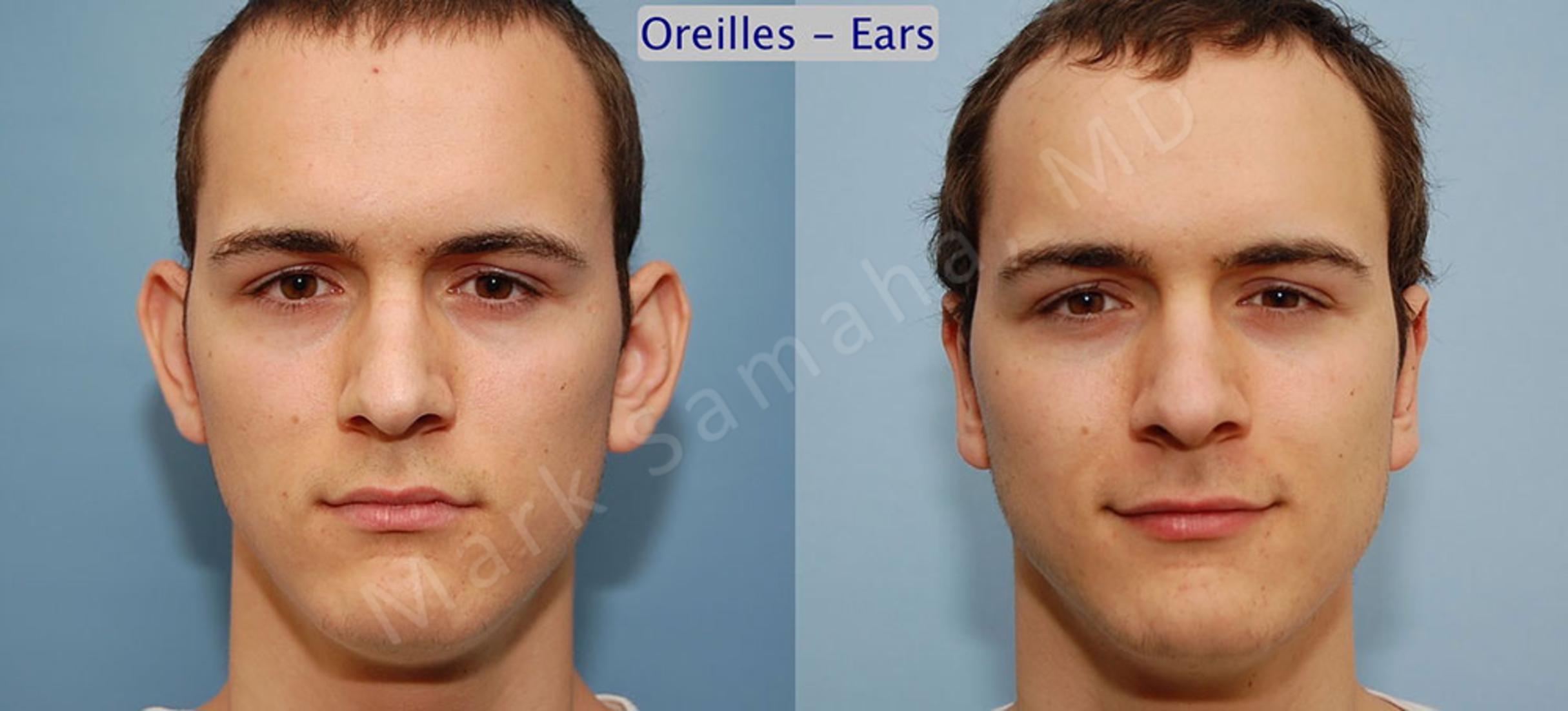Before & After Ear Surgery / Otoplastie Case 29 View #1 View in Mount Royal, QC