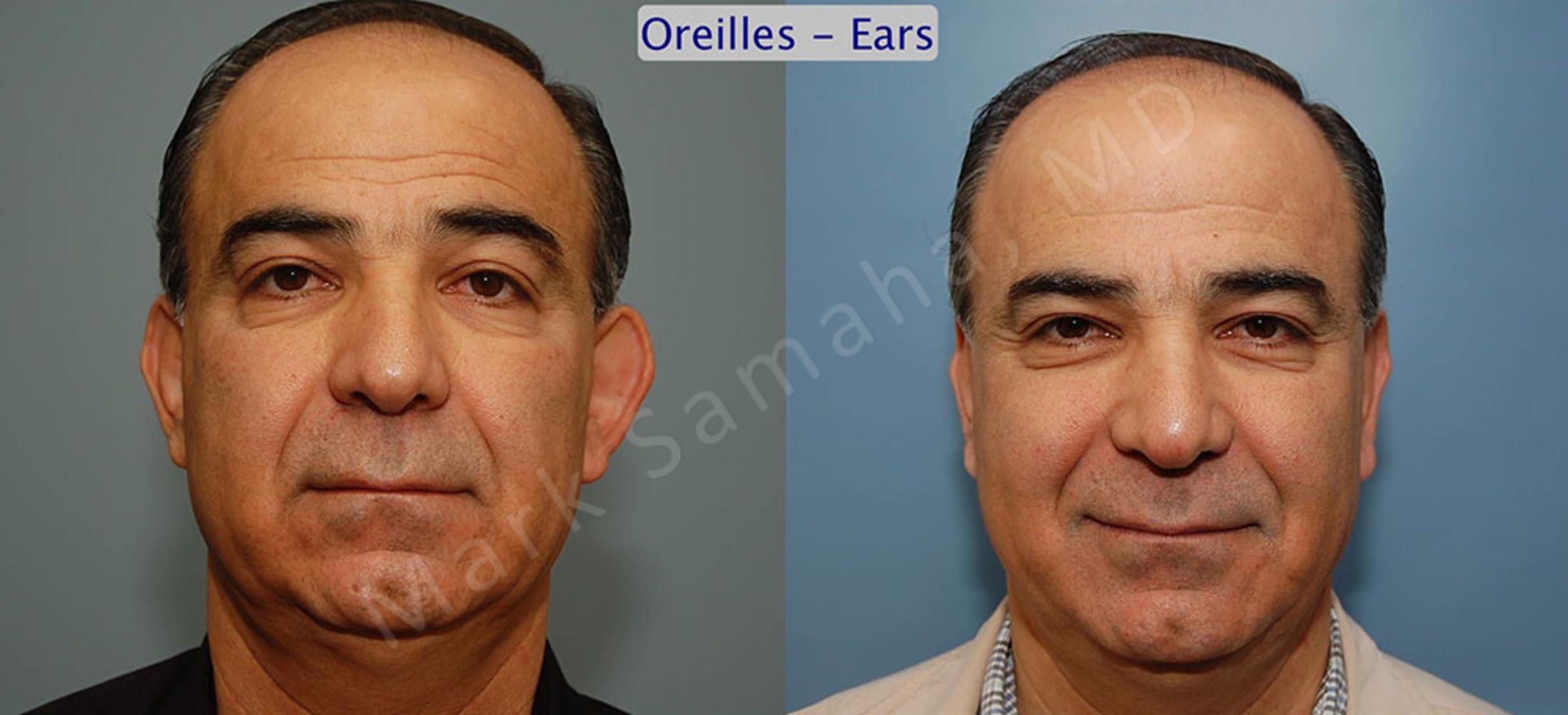 Before & After Ear Surgery / Otoplastie Case 30 View #1 View in Mount Royal, QC