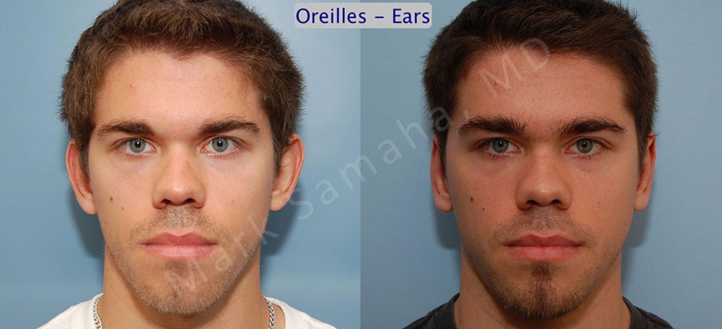 Before & After Ear Surgery / Otoplastie Case 31 View #1 View in Mount Royal, QC