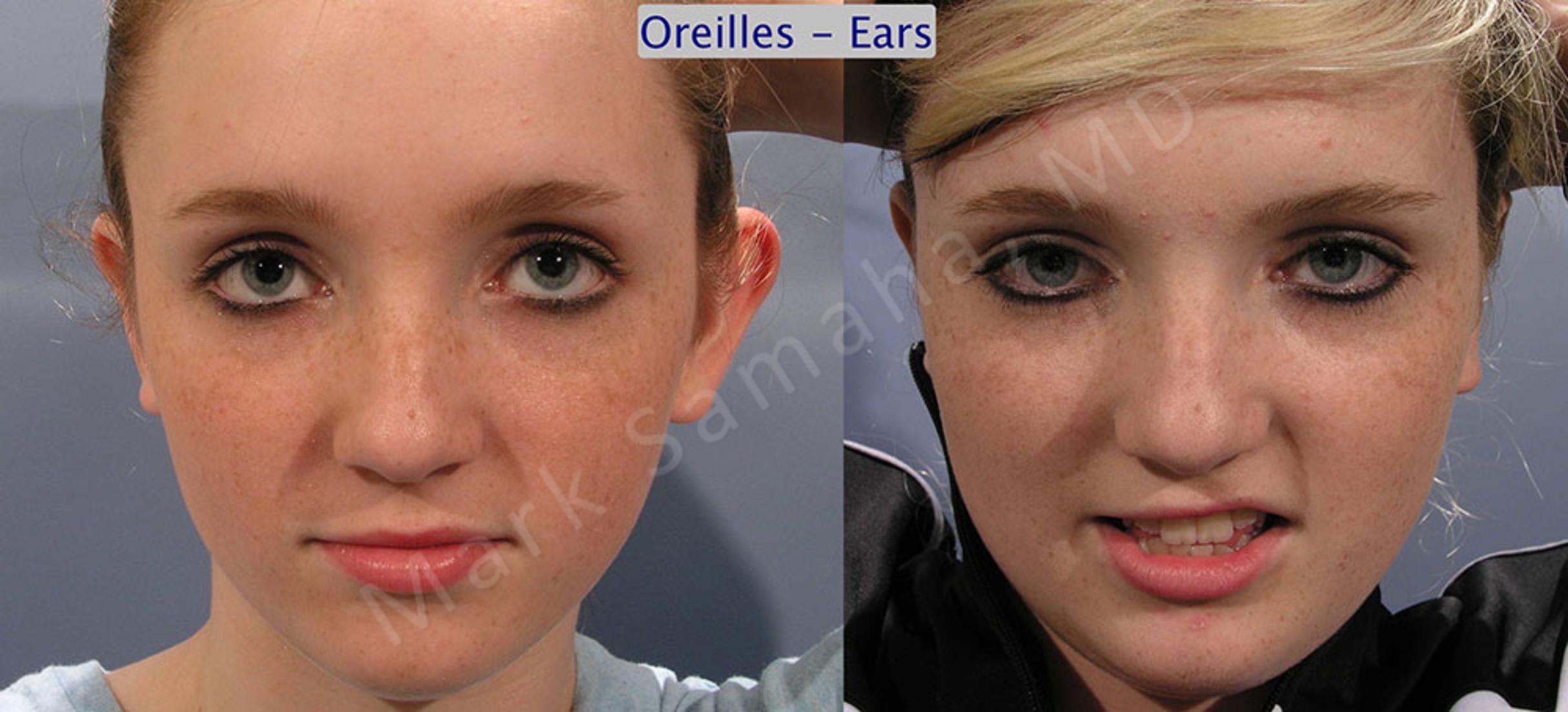 Before & After Ear Surgery / Otoplastie Case 32 View #1 View in Mount Royal, QC