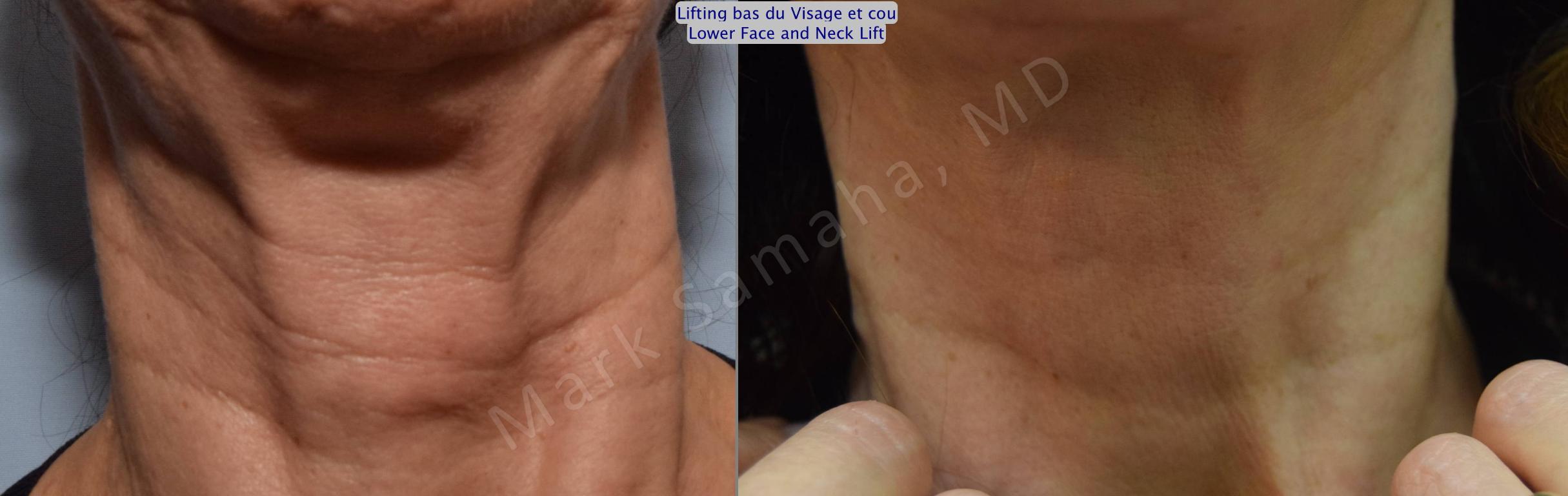 Before & After Facelift / Necklift - Lifting du visage / Cou Case 101 View #2 View in Mount Royal, QC