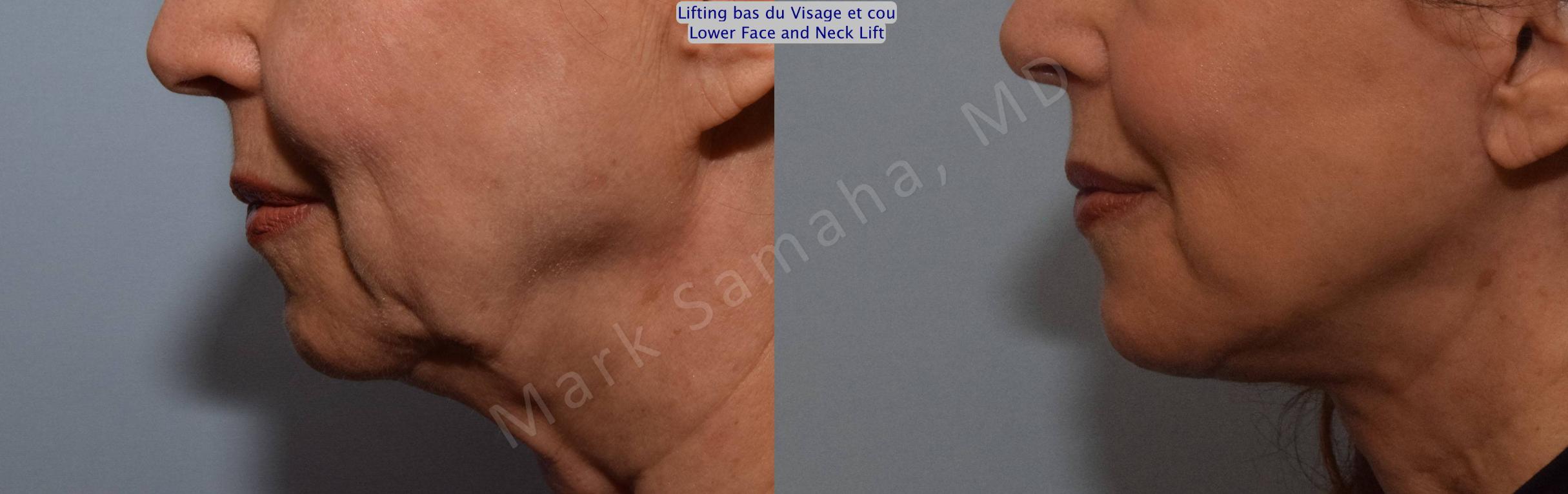 Before & After Lifting du visage / Cou - Facelift / Necklift Case 101 View #3 View in Mount Royal, QC