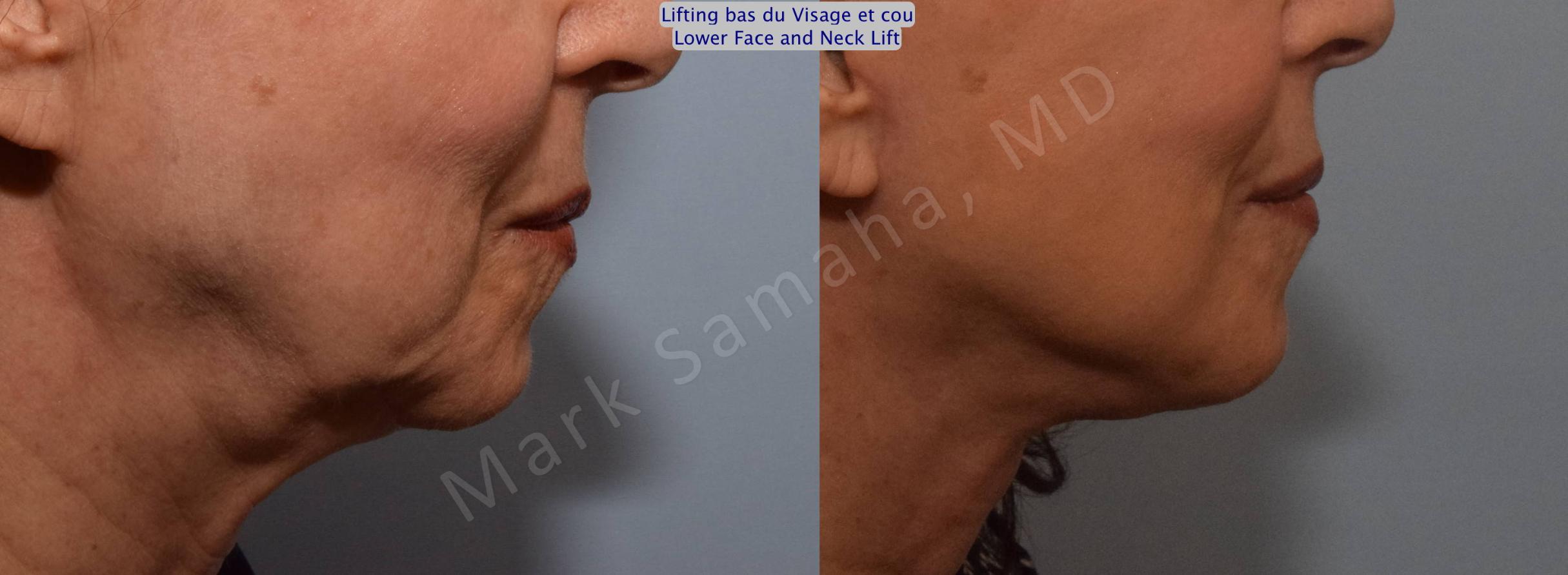 Before & After Facelift / Necklift - Lifting du visage / Cou Case 101 View #4 View in Mount Royal, QC