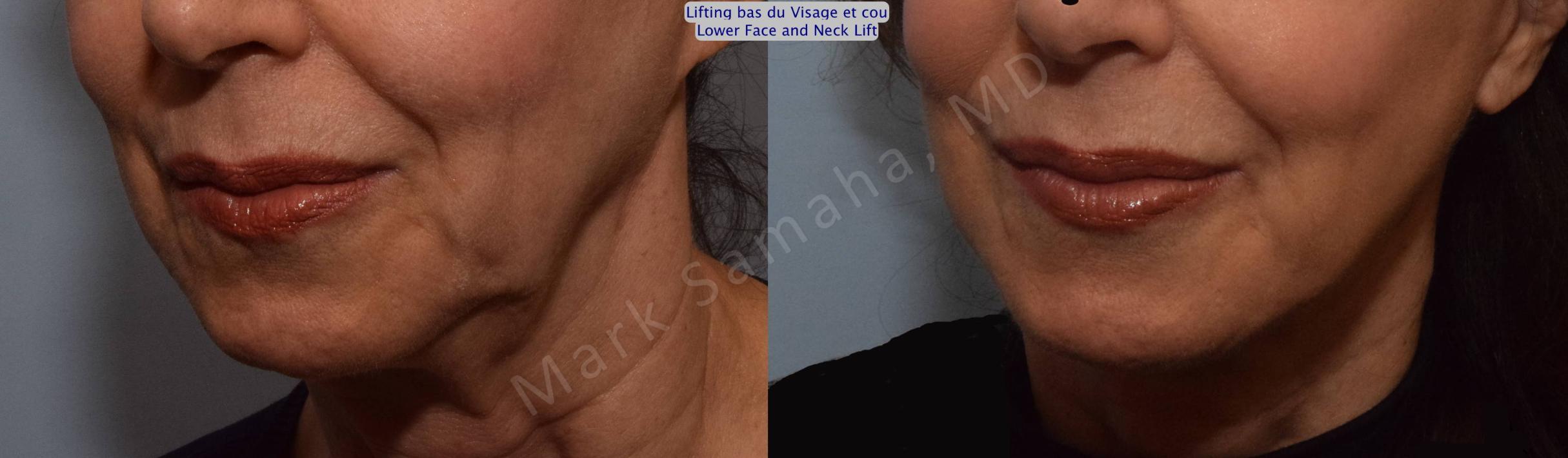 Before & After Lifting du visage / Cou - Facelift / Necklift Case 101 View #5 View in Mount Royal, QC