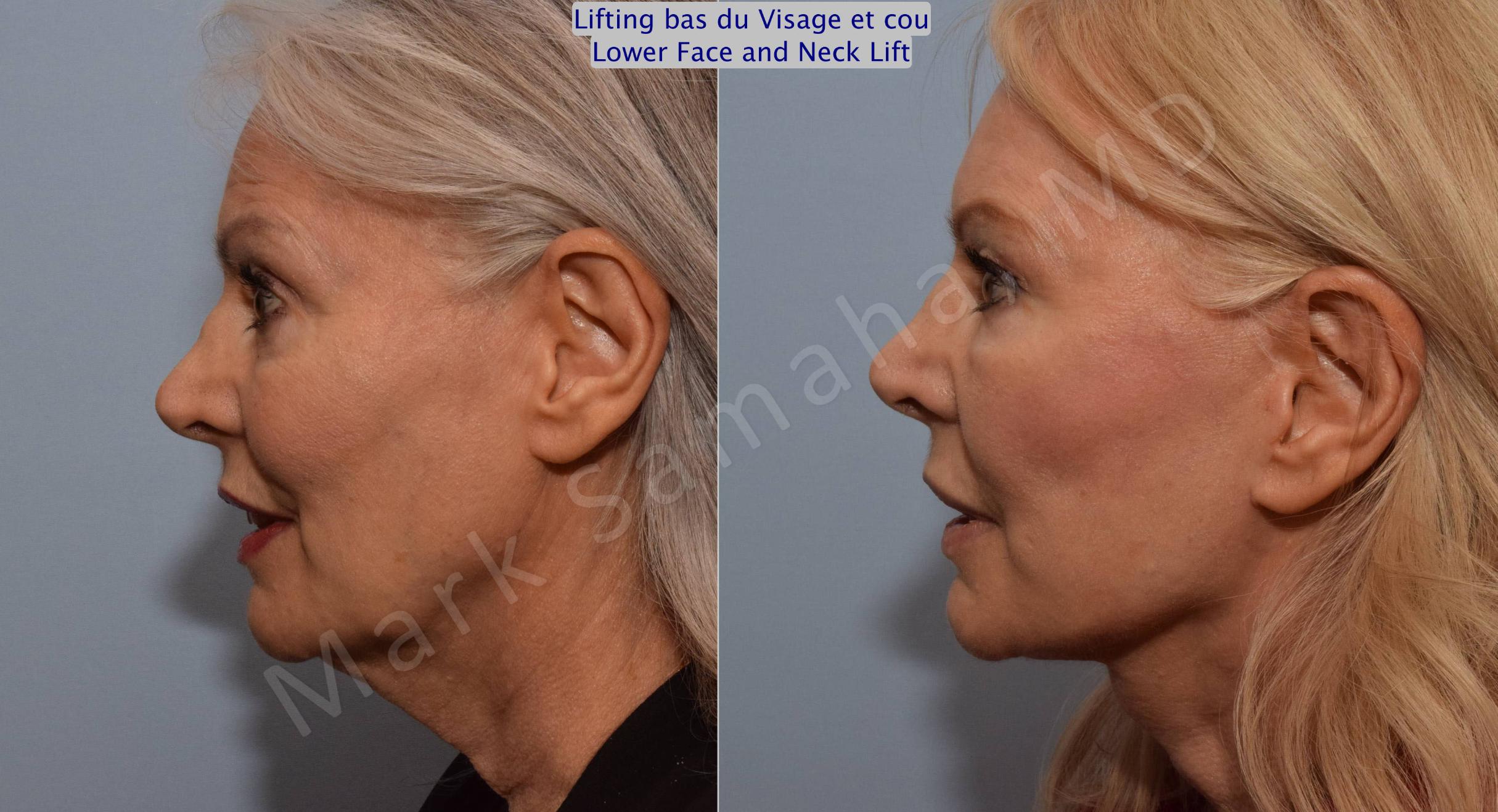 Before & After Facelift / Necklift - Lifting du visage / Cou Case 102 View #1 View in Mount Royal, QC