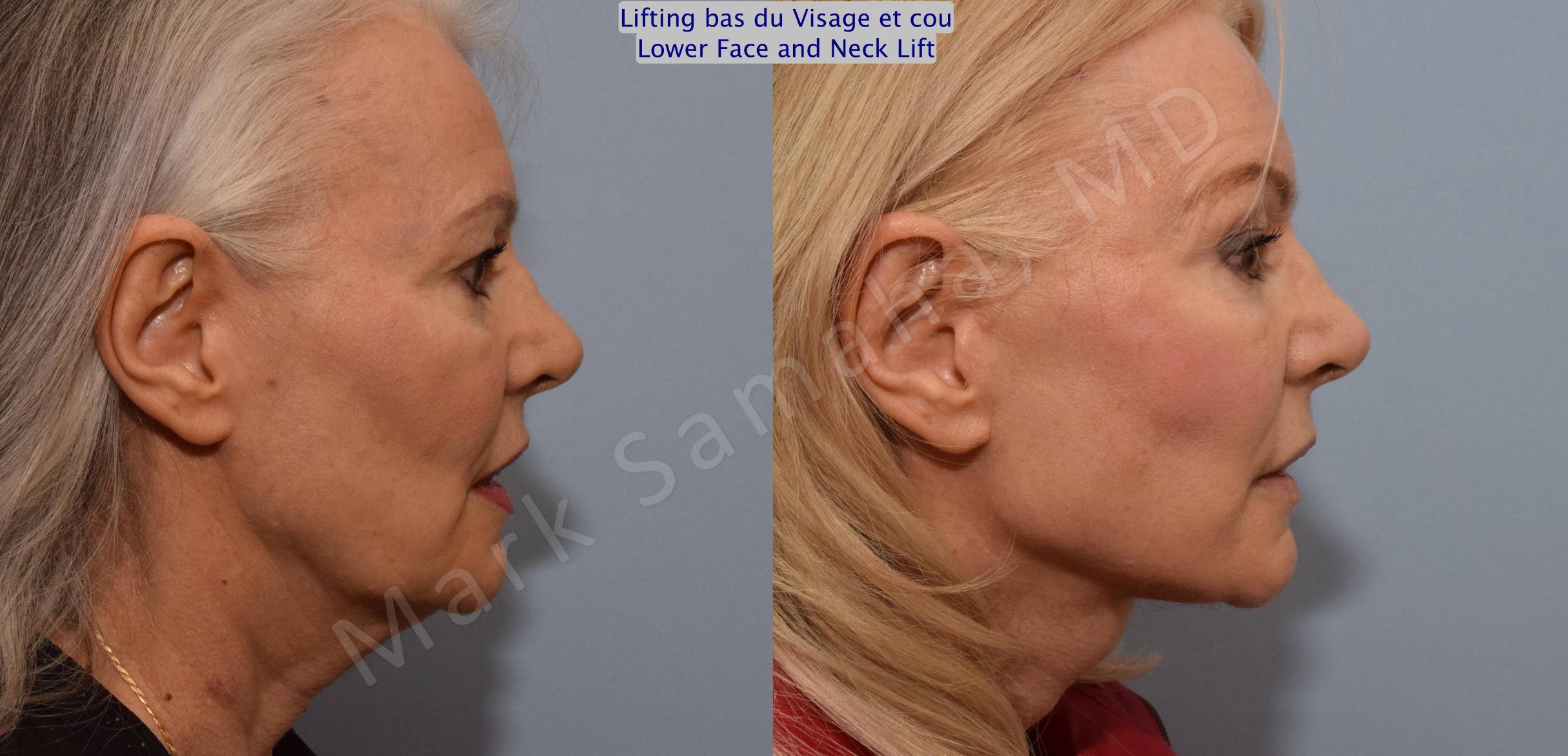 Before & After Facelift / Necklift - Lifting du visage / Cou Case 102 View #2 View in Mount Royal, QC