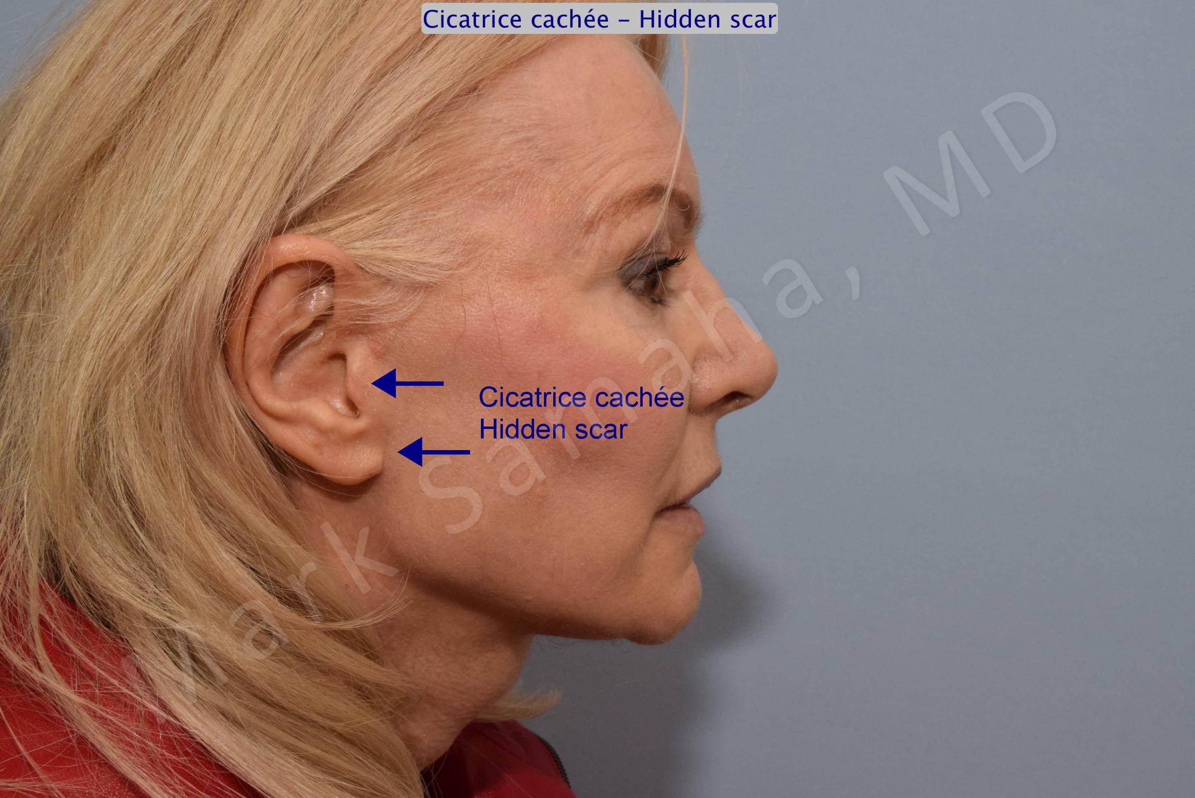 Before & After Facelift / Necklift - Lifting du visage / Cou Case 102 View #5 View in Mount Royal, QC