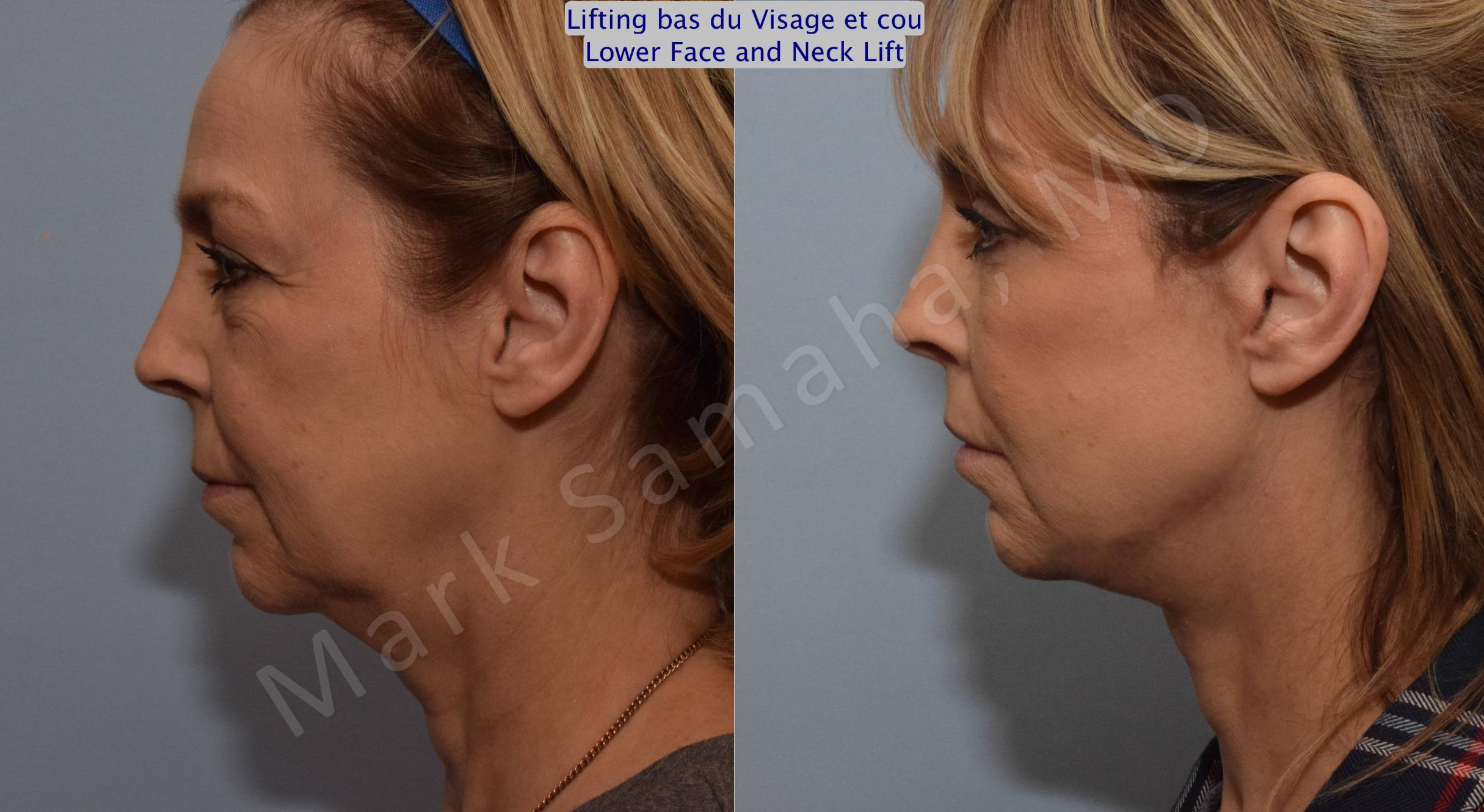 Before & After Facelift / Necklift - Lifting du visage / Cou Case 103 View #1 View in Mount Royal, QC