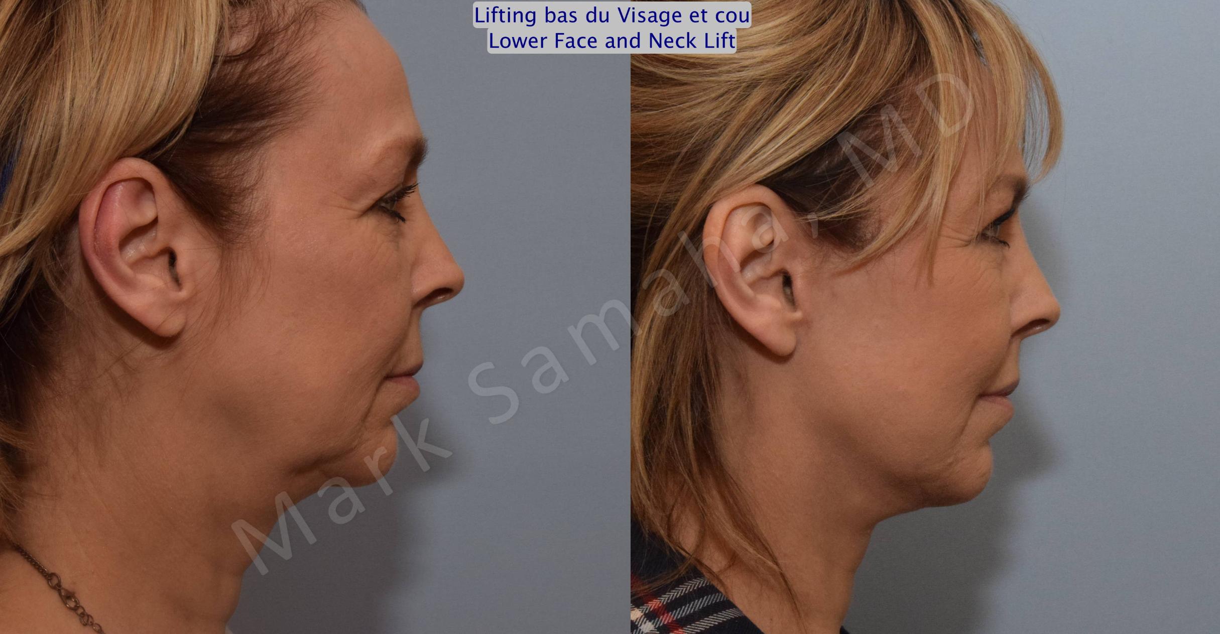 Before & After Facelift / Necklift - Lifting du visage / Cou Case 103 View #2 View in Mount Royal, QC