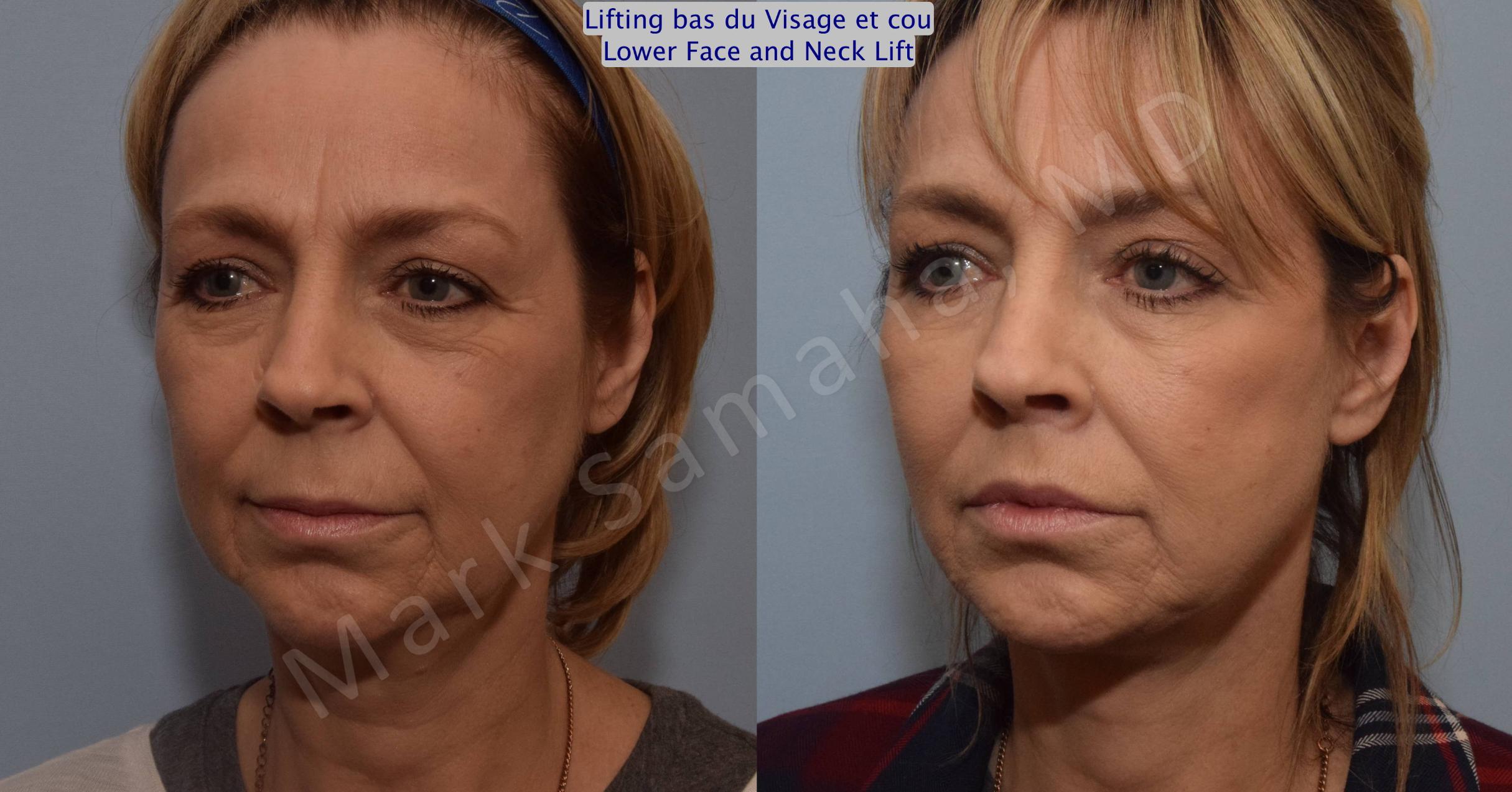 Before & After Facelift / Necklift - Lifting du visage / Cou Case 103 View #3 View in Mount Royal, QC