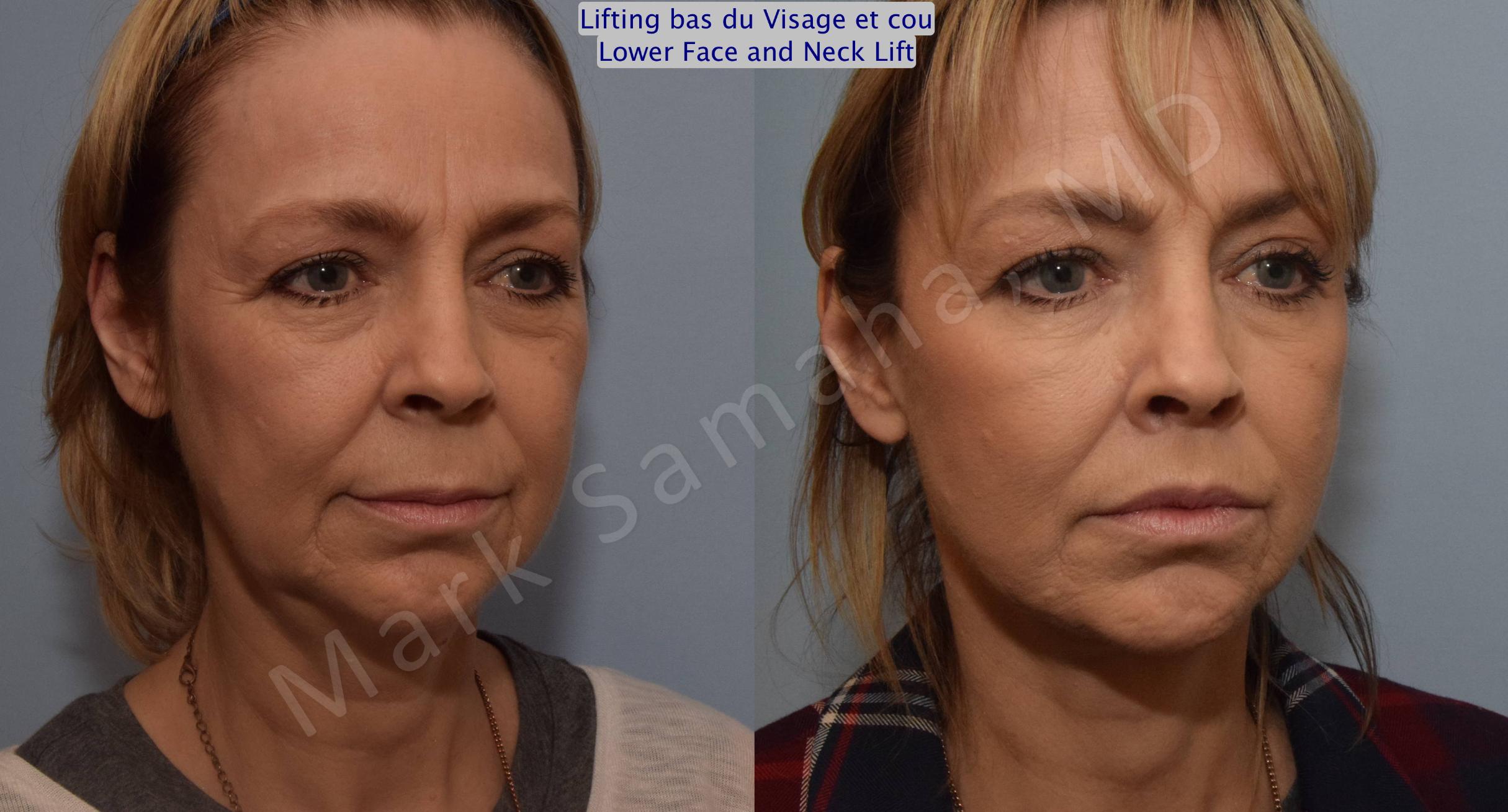 Before & After Lifting du visage / Cou - Facelift / Necklift Case 103 View #4 View in Mount Royal, QC