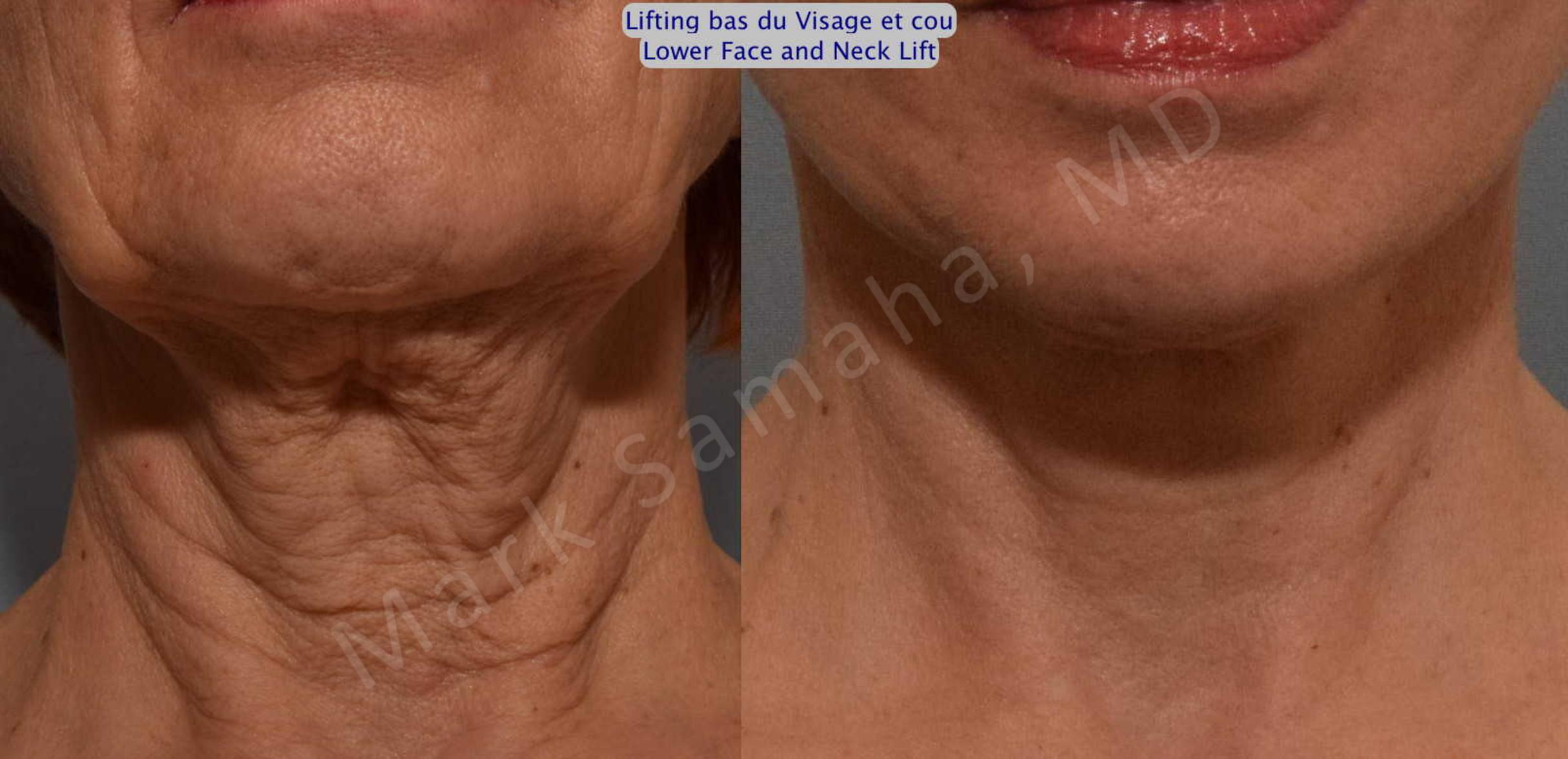 Before & After Facelift / Necklift - Lifting du visage / Cou Case 116 View #2 View in Mount Royal, QC