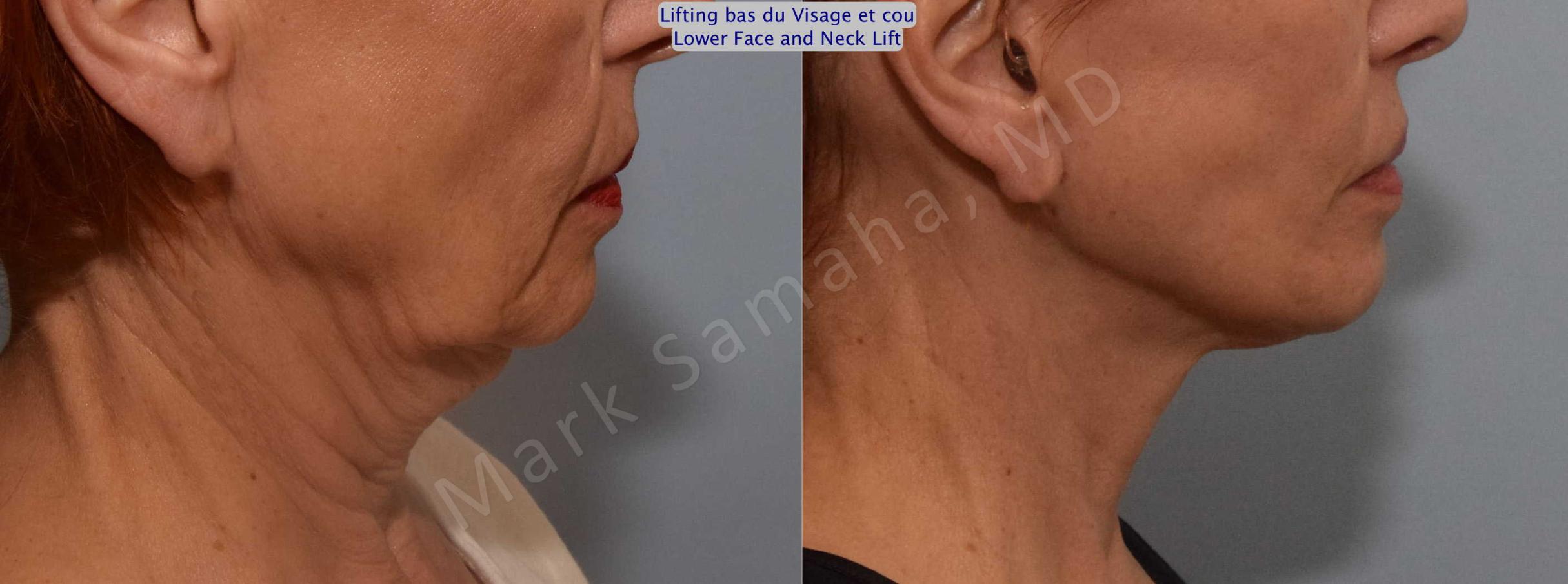 Before & After Facelift / Necklift - Lifting du visage / Cou Case 116 View #4 View in Mount Royal, QC