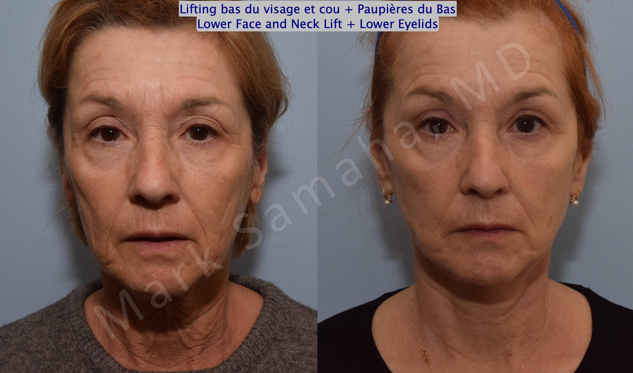 Before & After Facelift / Necklift - Lifting du visage / Cou Case 128 View #1 View in Mount Royal, QC