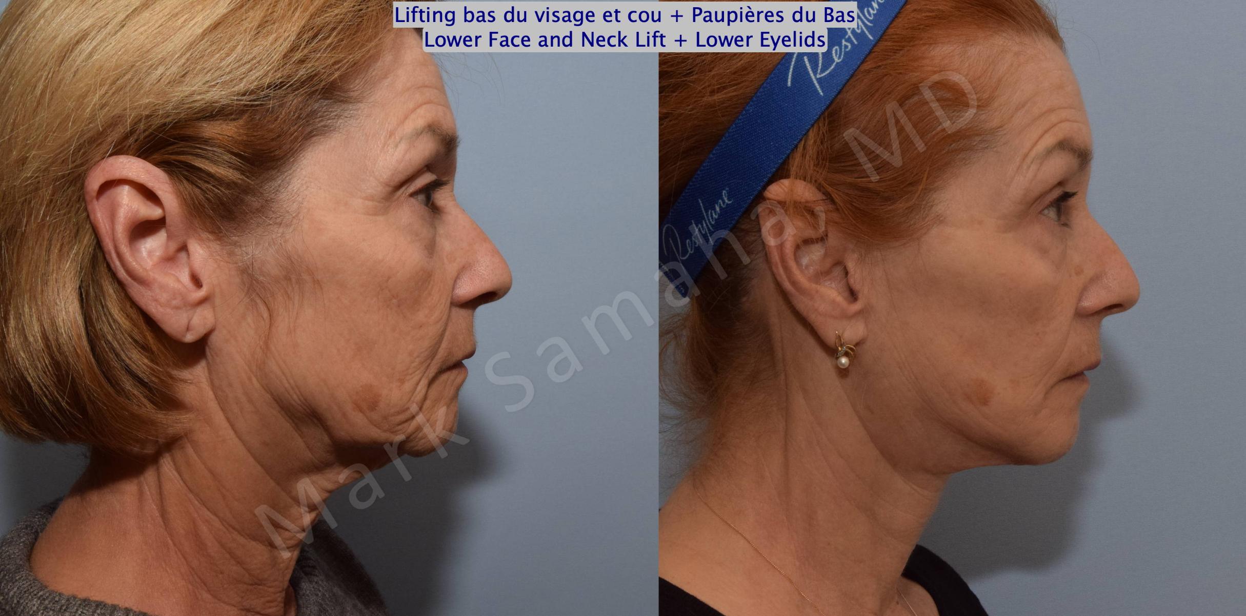 Before & After Facelift / Necklift - Lifting du visage / Cou Case 128 View #4 View in Mount Royal, QC