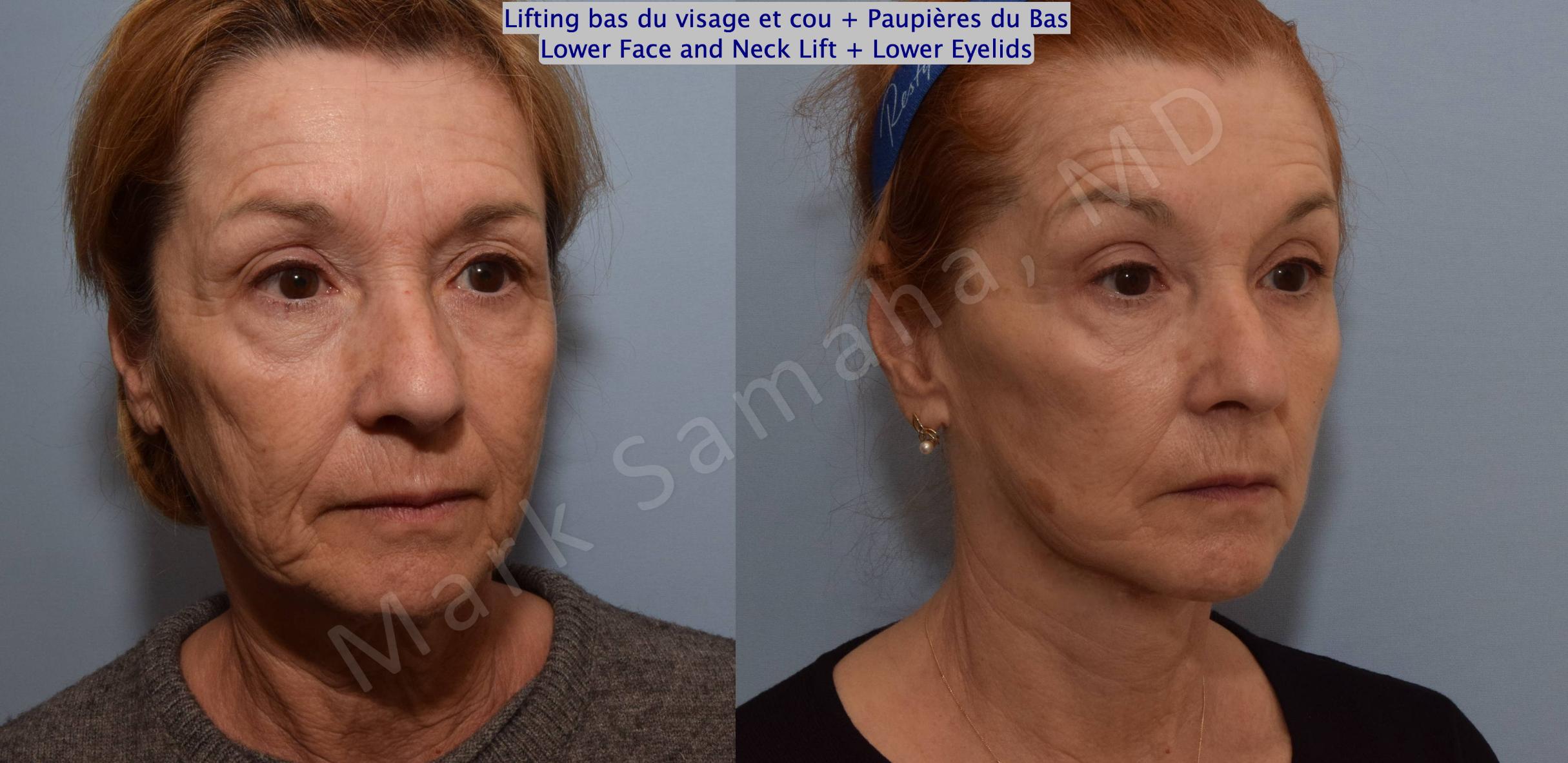 Before & After Blepharoplasty / Blépharoplastie Case 128 View #6 View in Mount Royal, QC