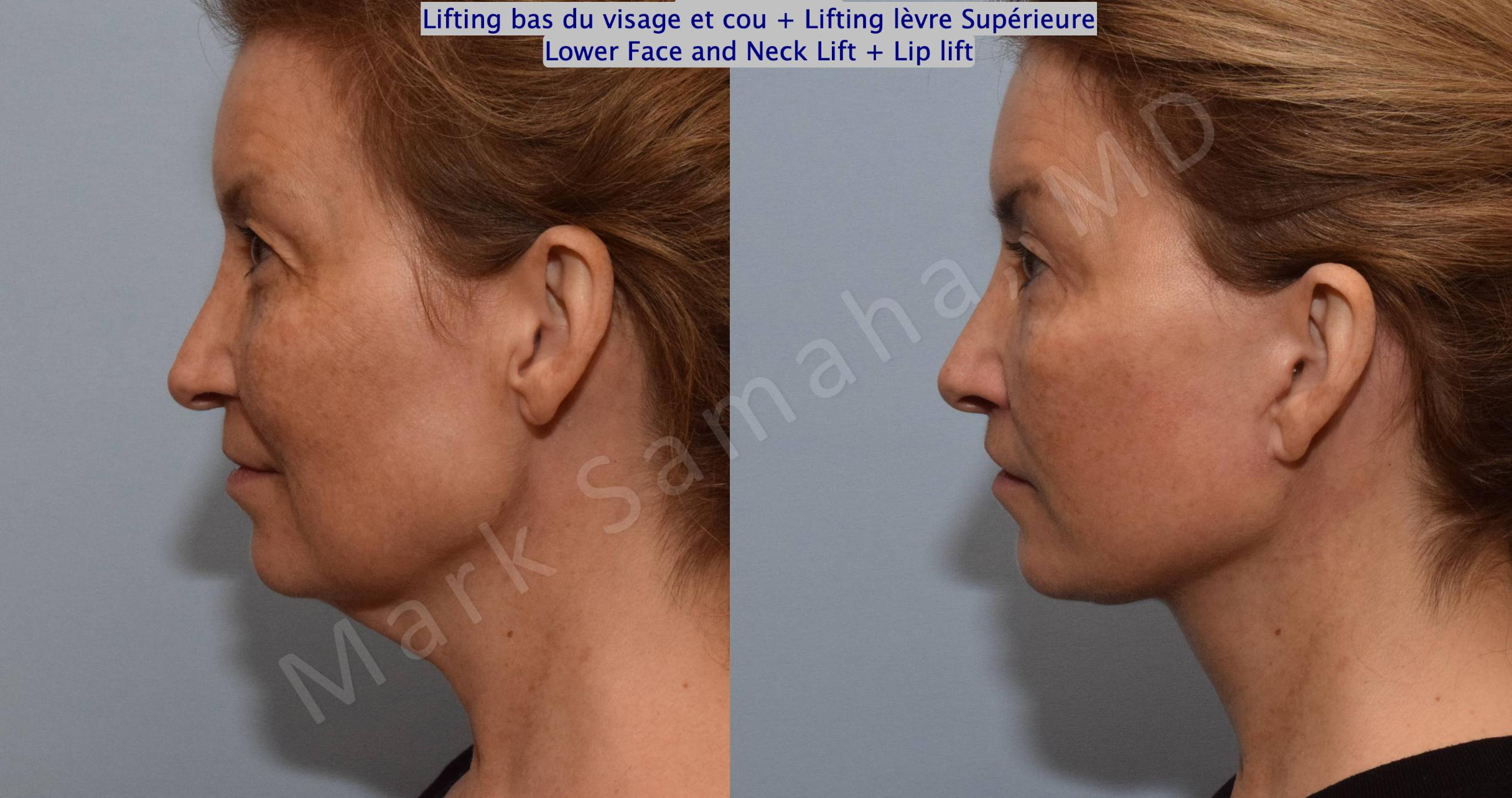 Before & After Lifting du visage / Cou - Facelift / Necklift Case 130 View #3 View in Mount Royal, QC