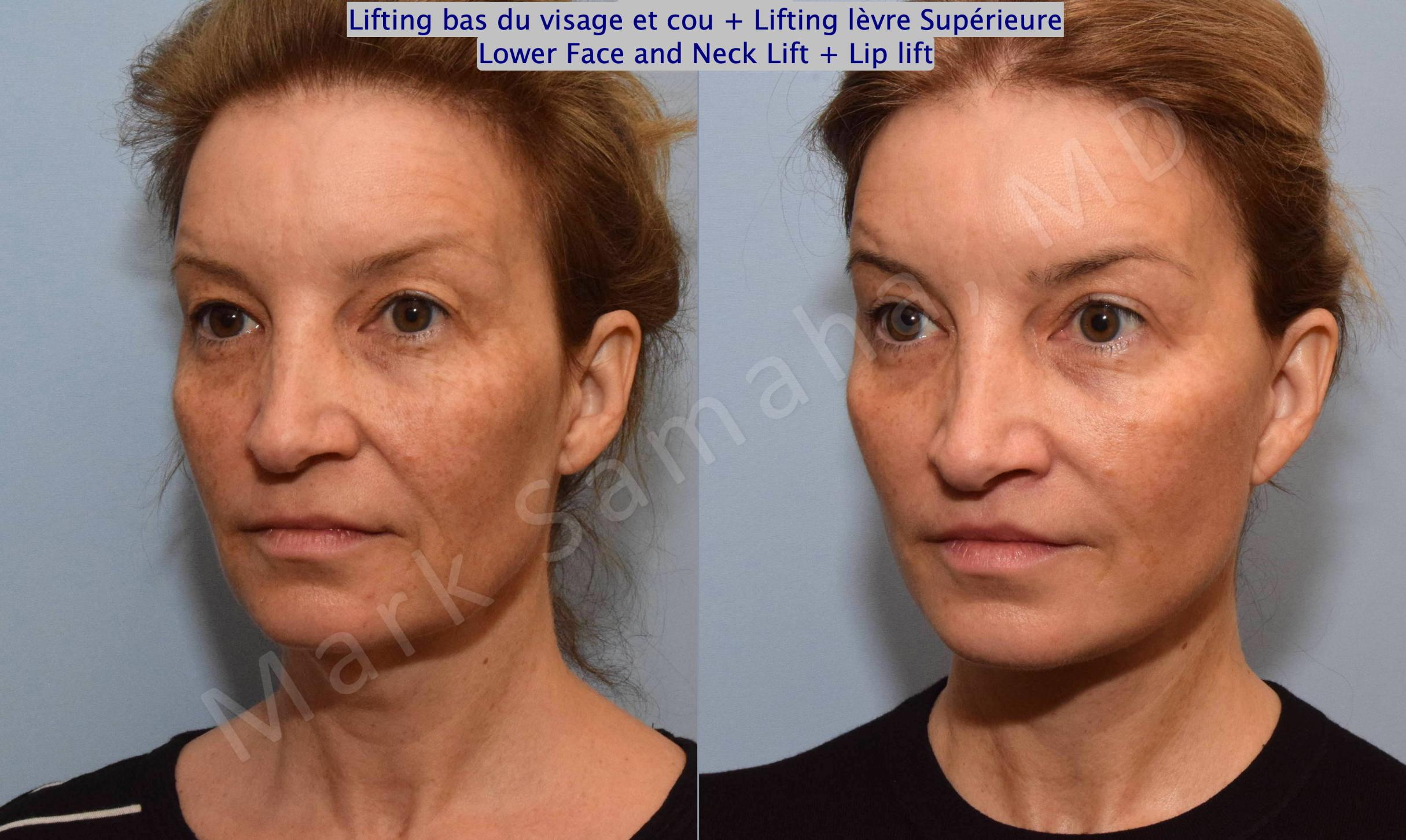 Before & After Lifting du visage / Cou - Facelift / Necklift Case 130 View #5 View in Mount Royal, QC