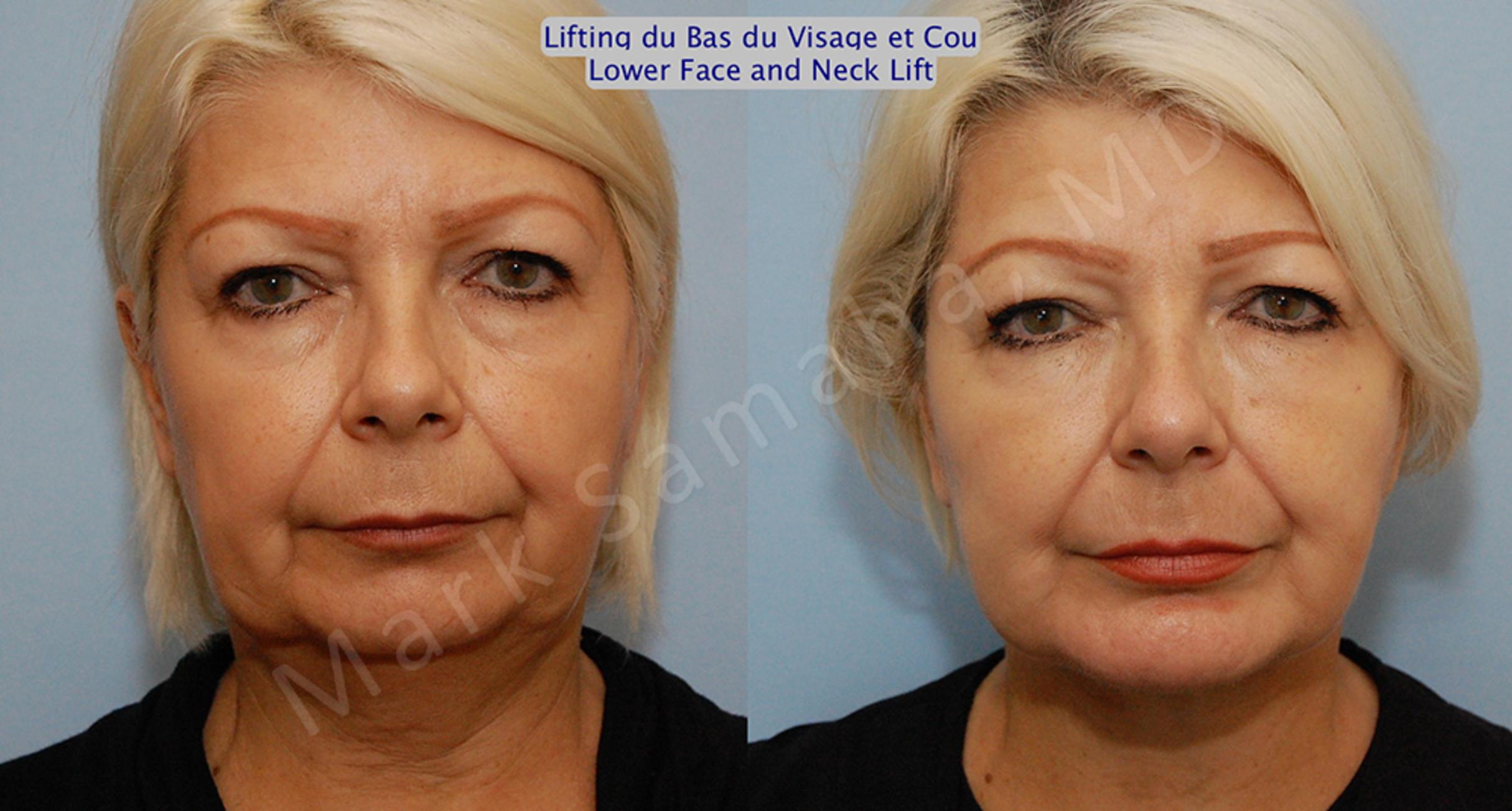 Before & After Facelift / Necklift - Lifting du visage / Cou Case 14 View #1 View in Mount Royal, QC