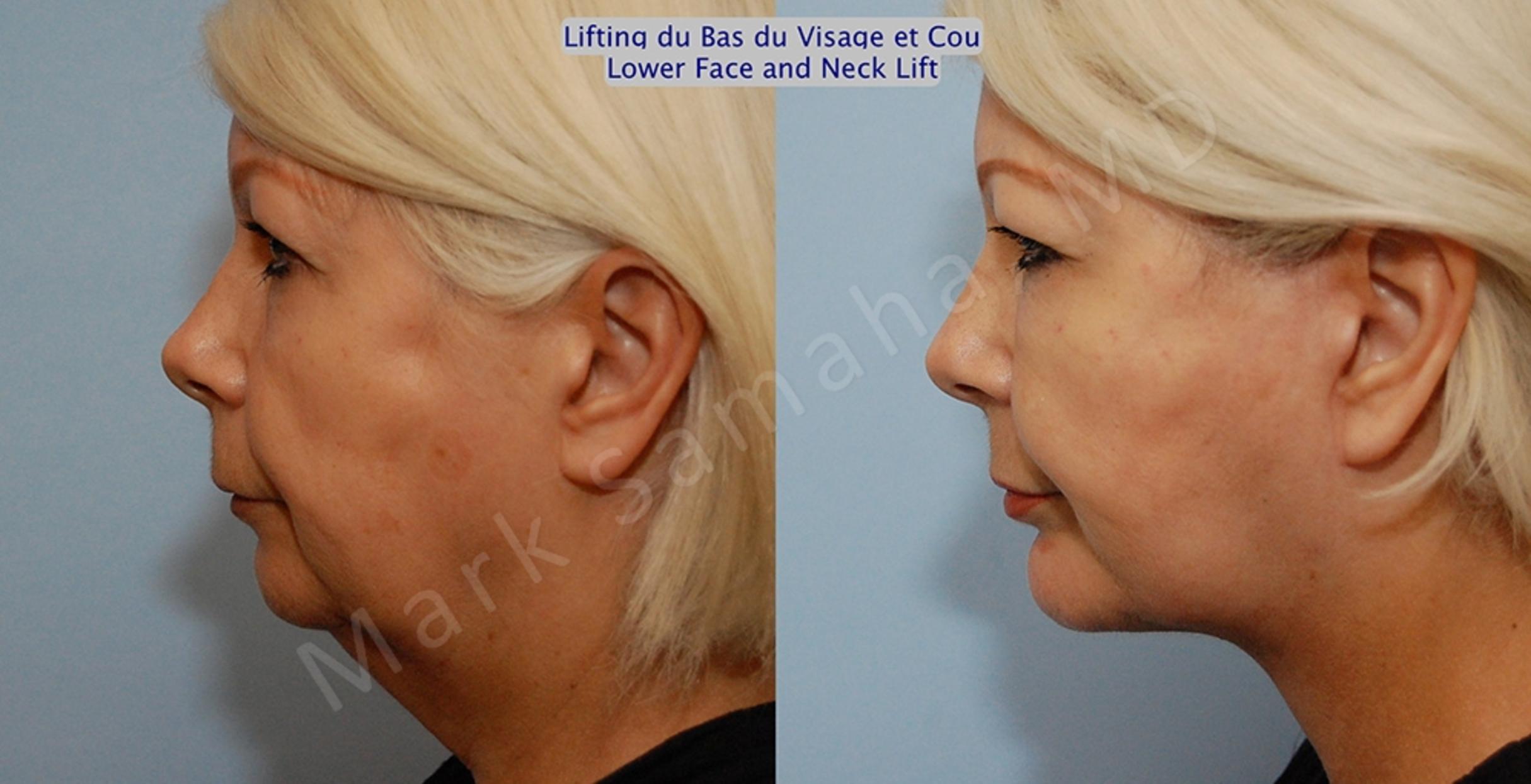 Before & After Lifting du visage / Cou - Facelift / Necklift Case 14 View #2 View in Mount Royal, QC