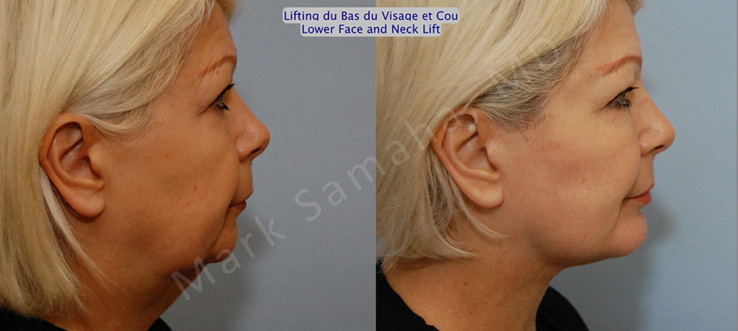 Before & After Lifting du visage / Cou - Facelift / Necklift Case 14 View #3 View in Mount Royal, QC
