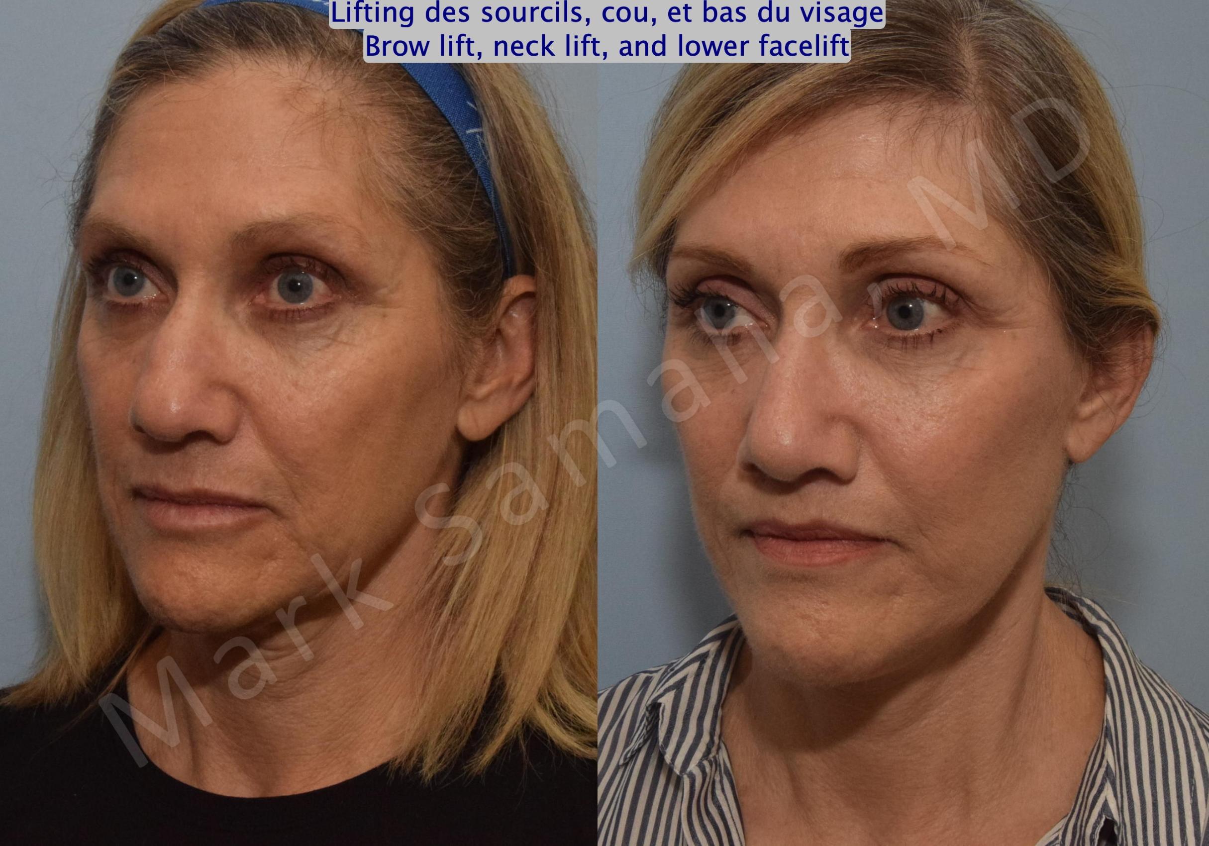 Before & After Lifting du Sourcil / Brow lift Case 145 Left Oblique View in Mount Royal, QC