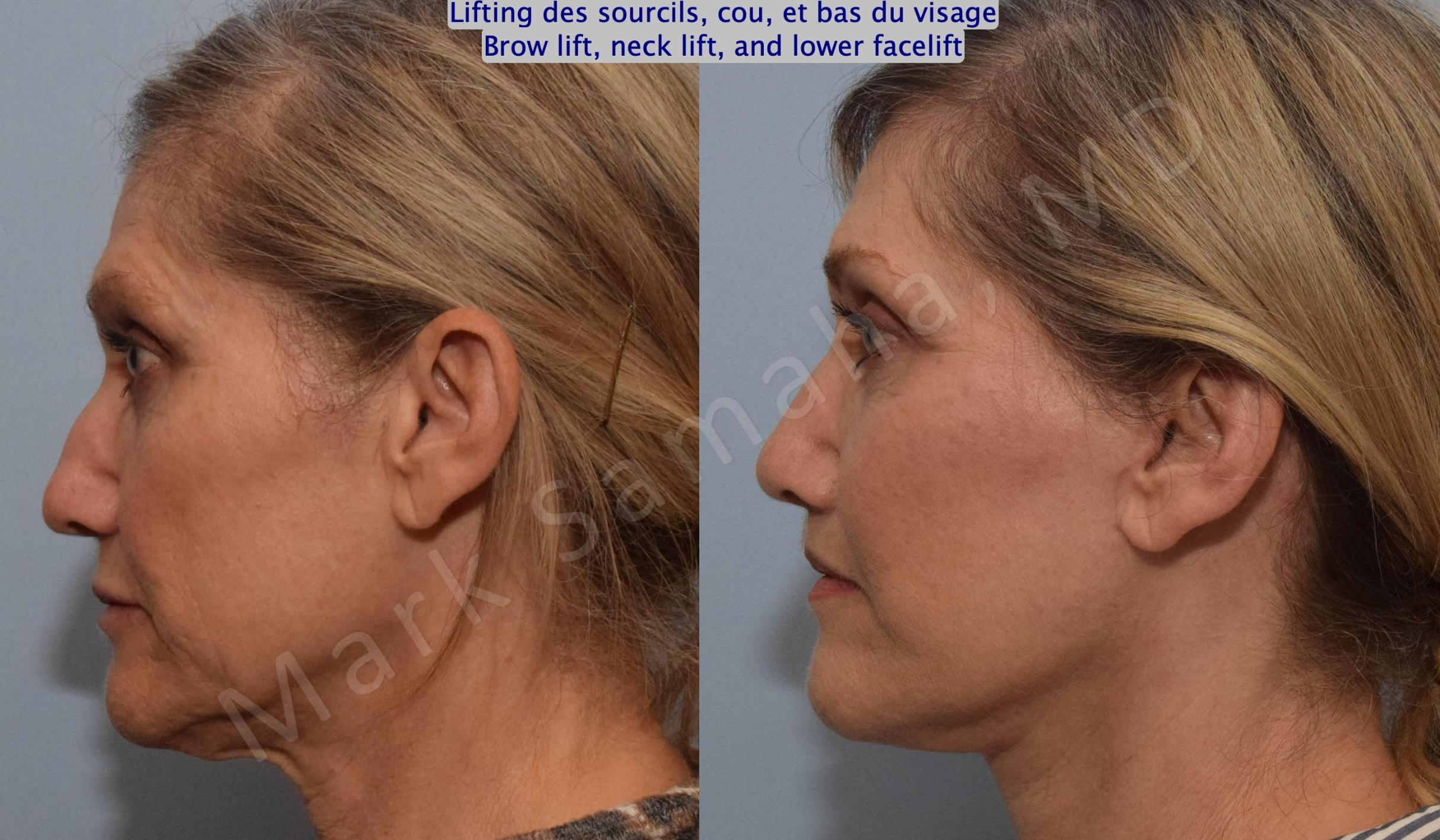 Before & After Lifting du Sourcil / Brow lift Case 145 Left Side View in Mount Royal, QC