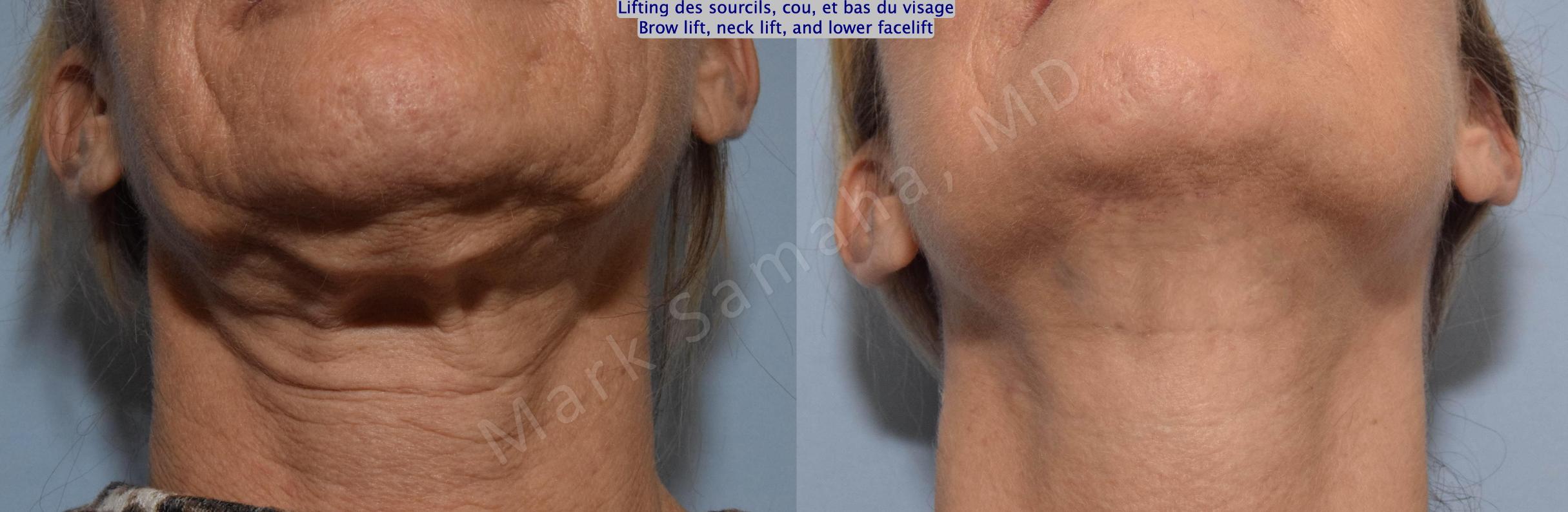 Before & After Lifting du Sourcil / Brow lift Case 145 Neck/Cou View in Mount Royal, QC