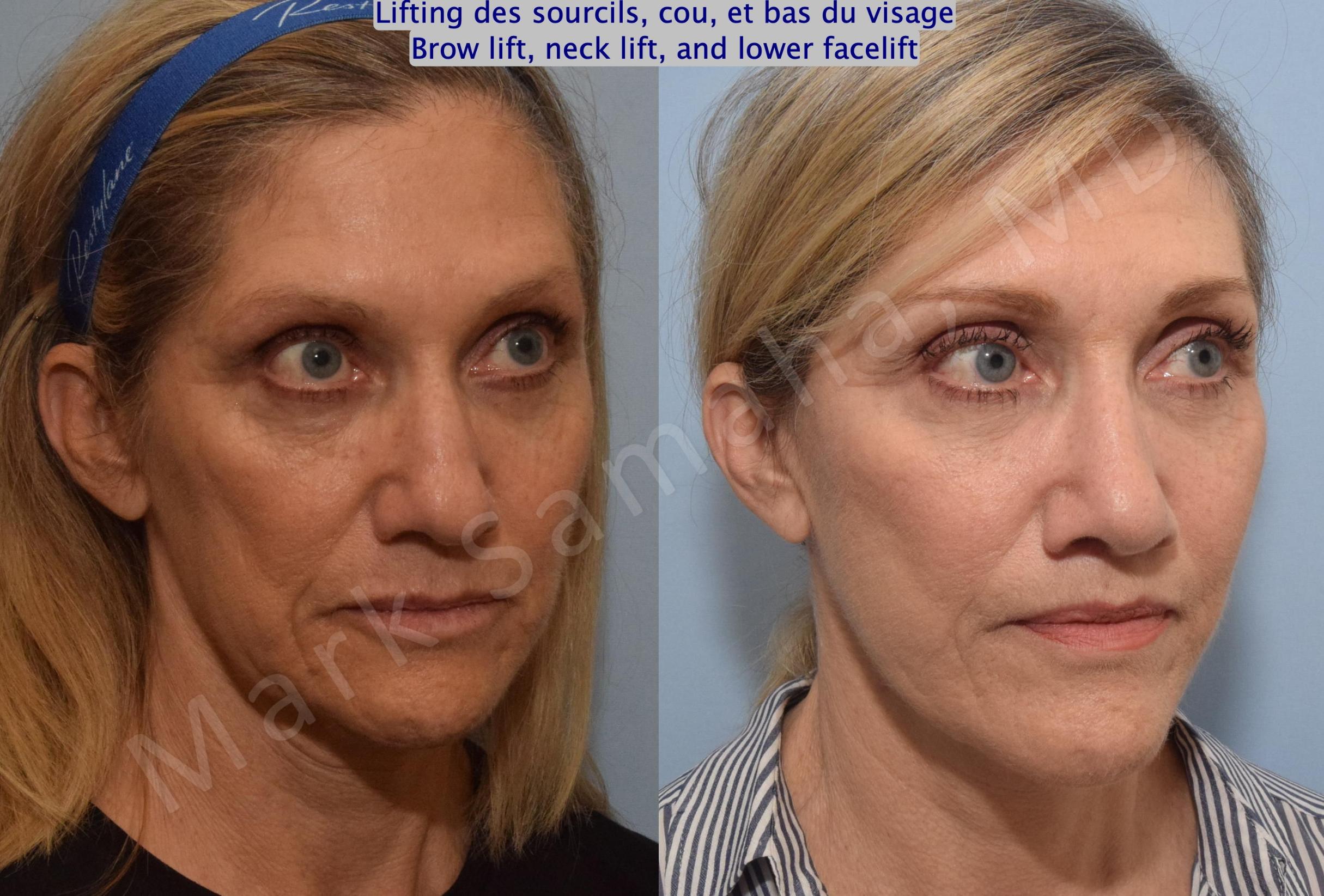 Before & After Lifting du Sourcil / Brow lift Case 145 Right Oblique View in Mount Royal, QC