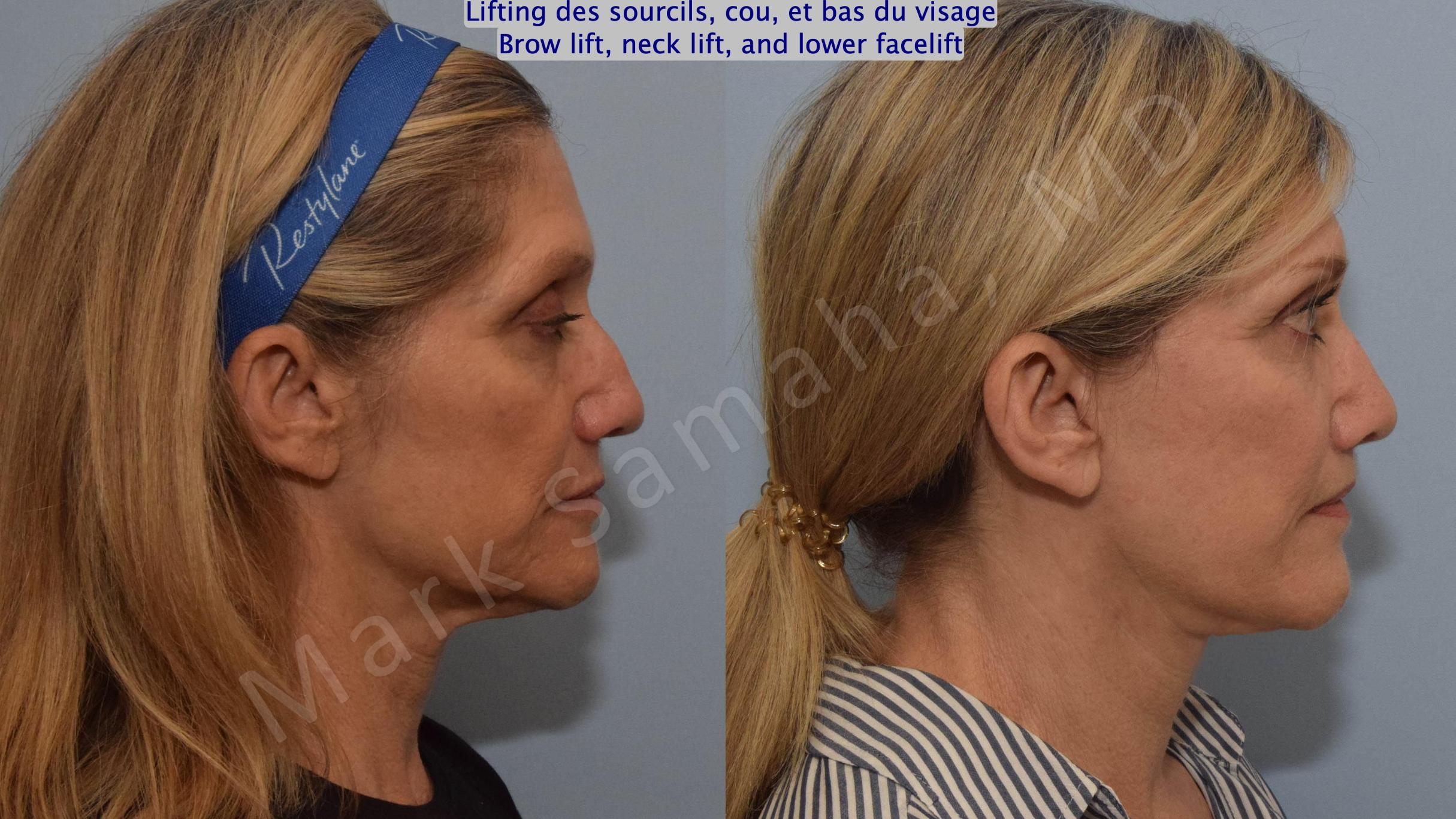 Before & After Lifting du Sourcil / Brow lift Case 145 Right Side View in Mount Royal, QC