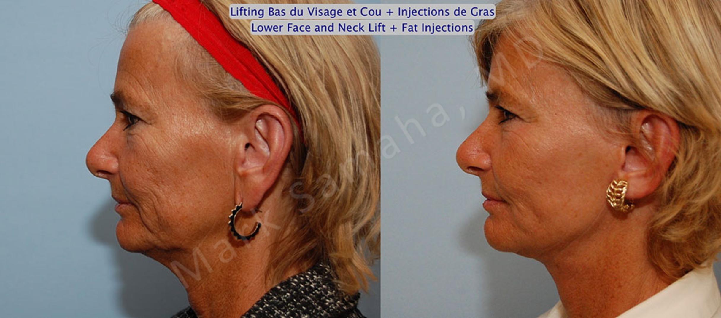Before & After Facelift / Necklift - Lifting du visage / Cou Case 15 View #2 View in Mount Royal, QC