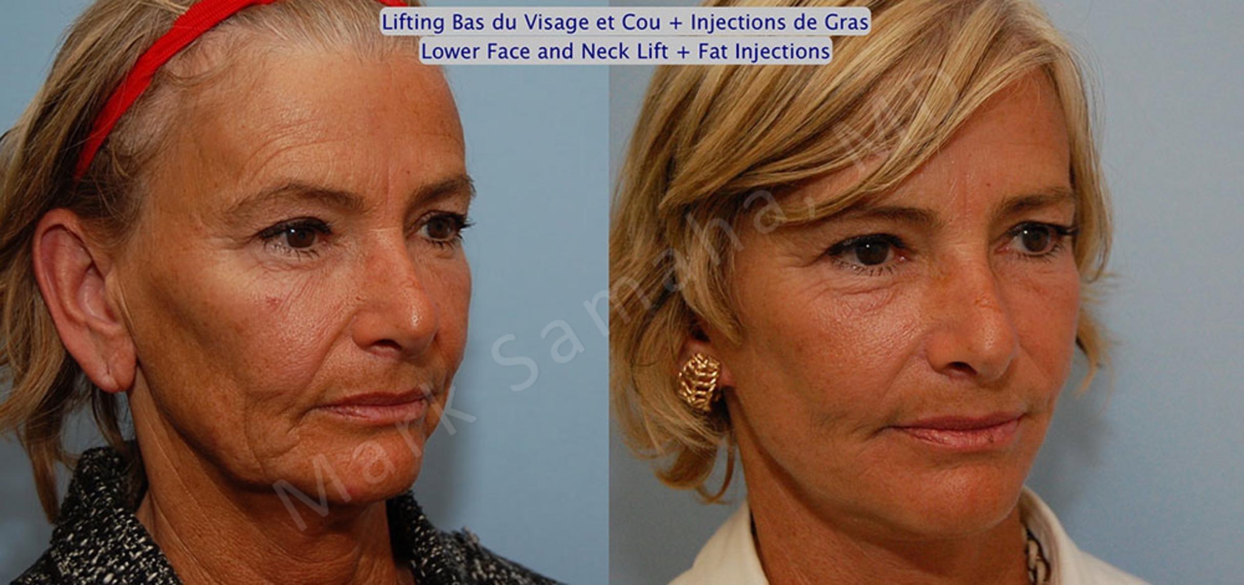 Before & After Facelift / Necklift - Lifting du visage / Cou Case 15 View #4 View in Mount Royal, QC