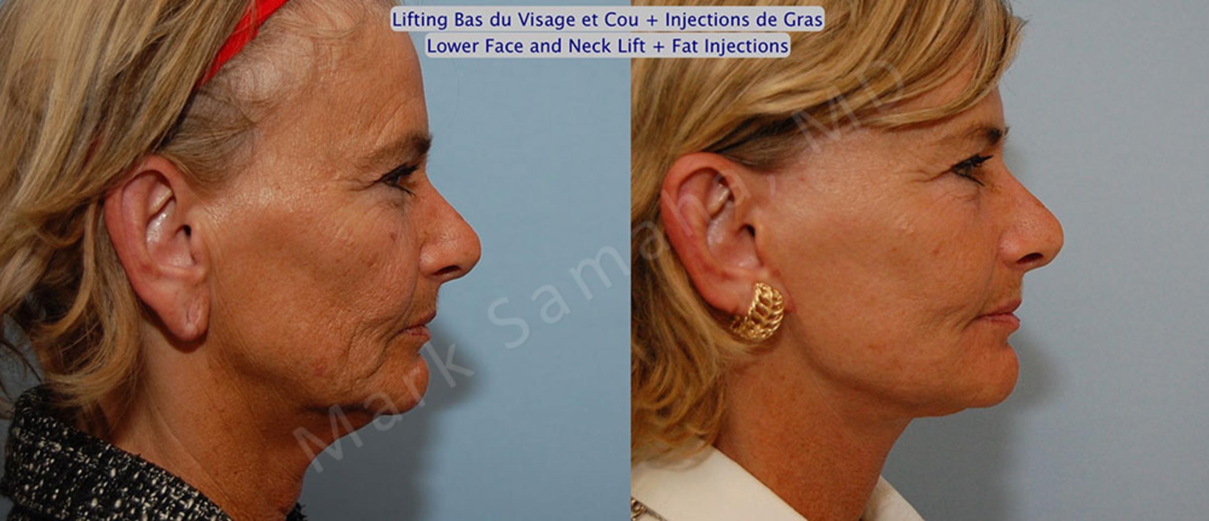 Before & After Facelift / Necklift - Lifting du visage / Cou Case 15 View #5 View in Mount Royal, QC