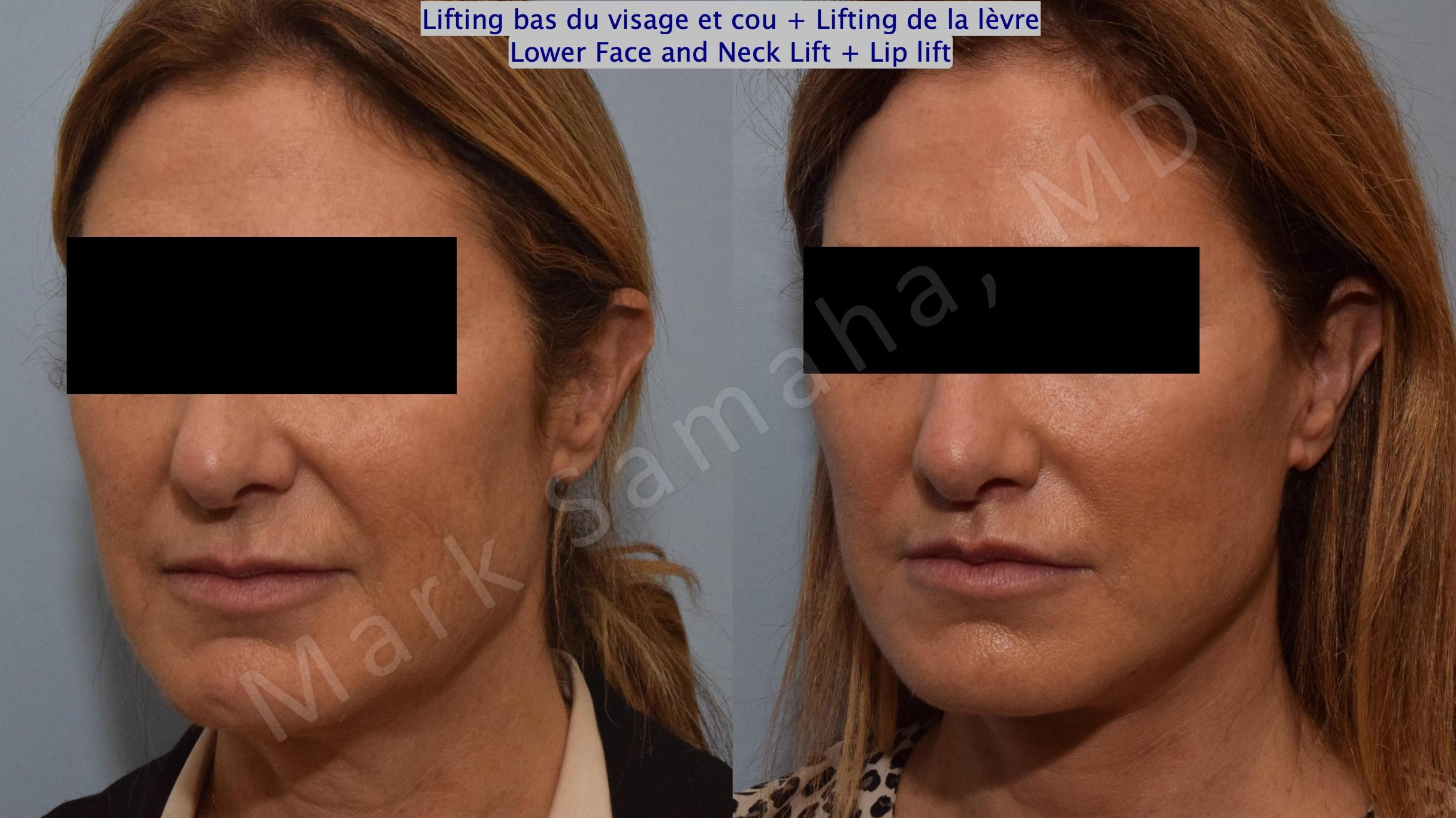 Before & After Lifting du visage / Cou - Facelift / Necklift Case 151 Left Oblique View in Mount Royal, QC