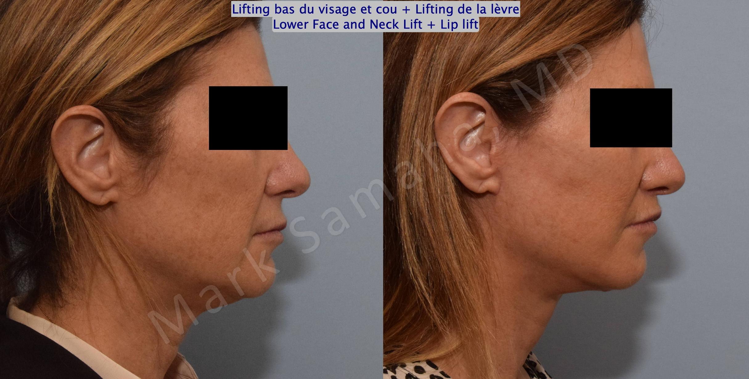 Before & After Facelift / Necklift - Lifting du visage / Cou Case 151 Right Side View in Mount Royal, QC