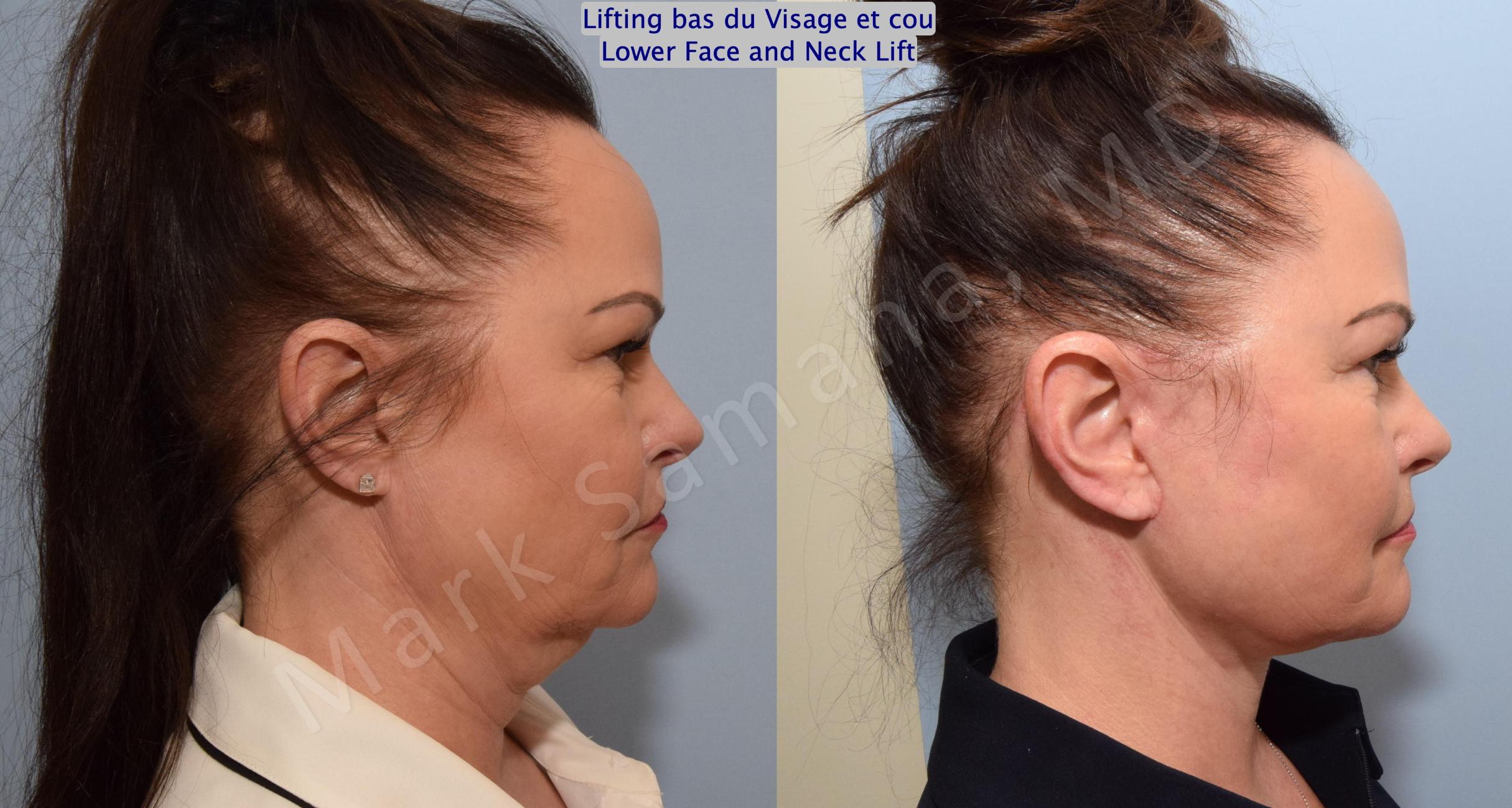 Before & After Facelift / Necklift - Lifting du visage / Cou Case 153 Right Side View in Mount Royal, QC